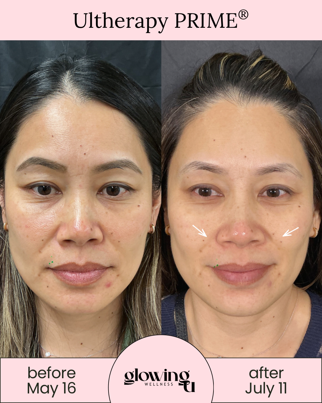Side-by-side comparison of a woman's face before and after Ultherapy treatment, showing visible skin improvements, with the before photo dated May 16 and the after photo dated July 11.