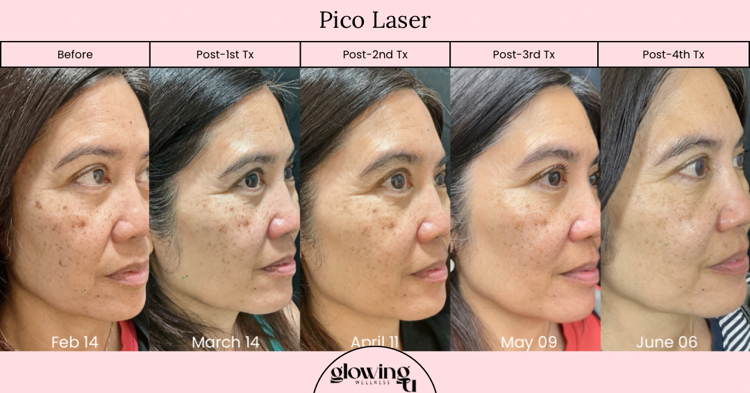Progress photos of a woman's face showing improvement in skin condition after Pico Laser treatments over several months, from February 14 to June 6.