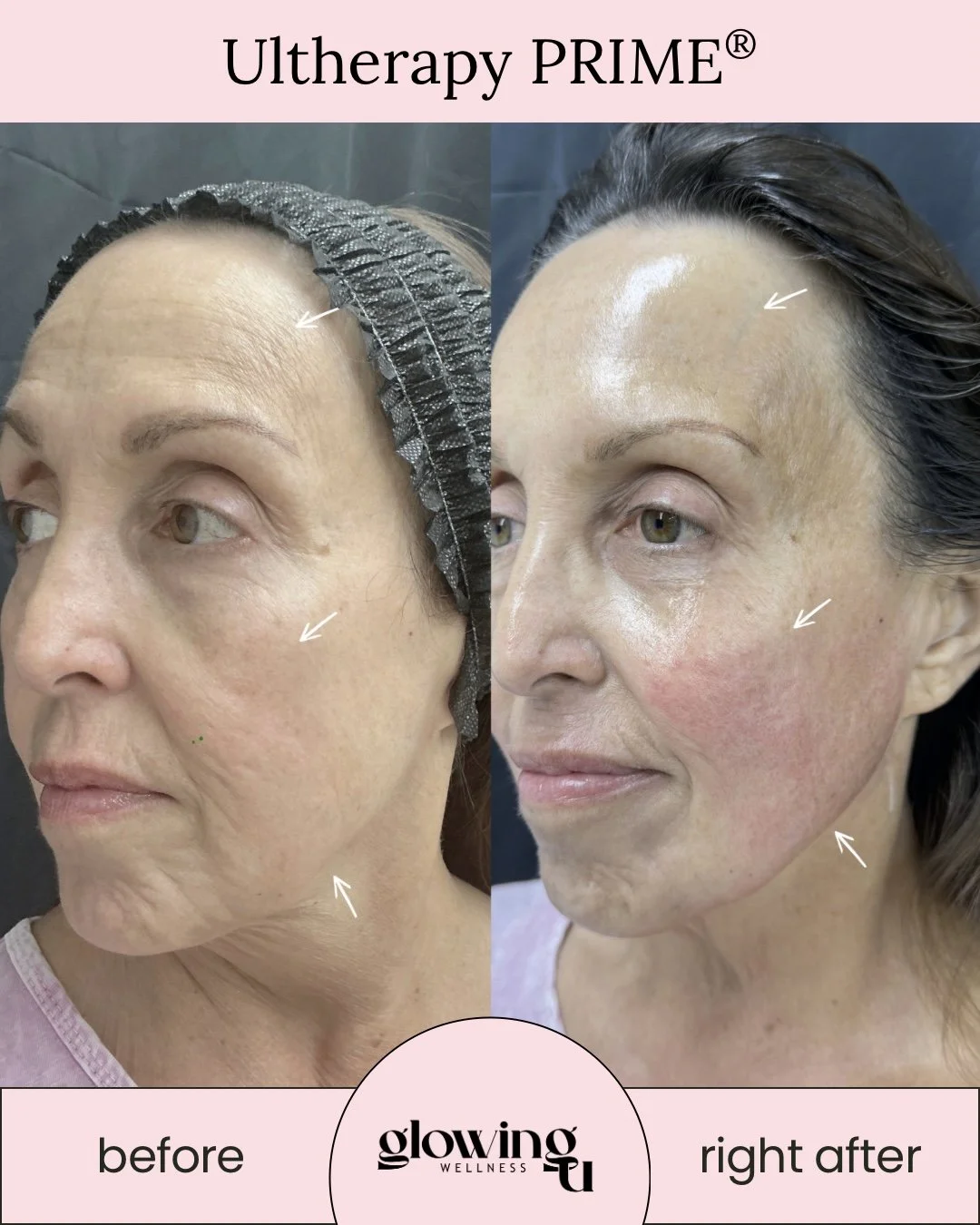 before after pic of Ultherapy Prime at Glowing U Wellness in Torrance