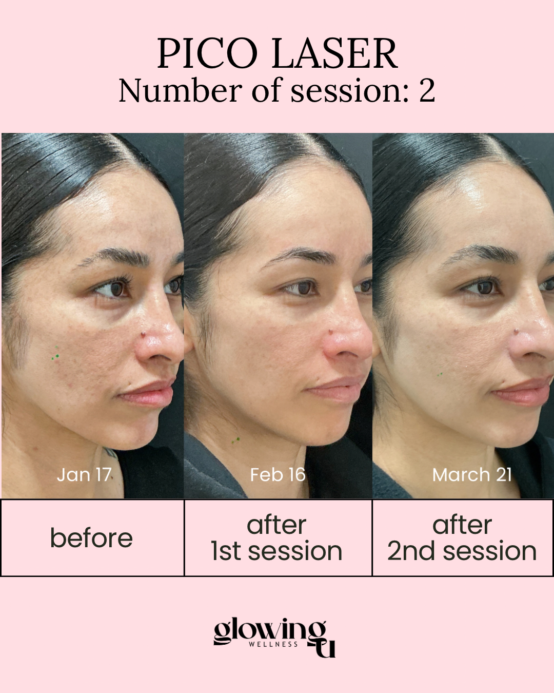 Progress photos showing a woman's face before, after first, and after second Pico Laser sessions, with visible reduction in skin imperfections over time.