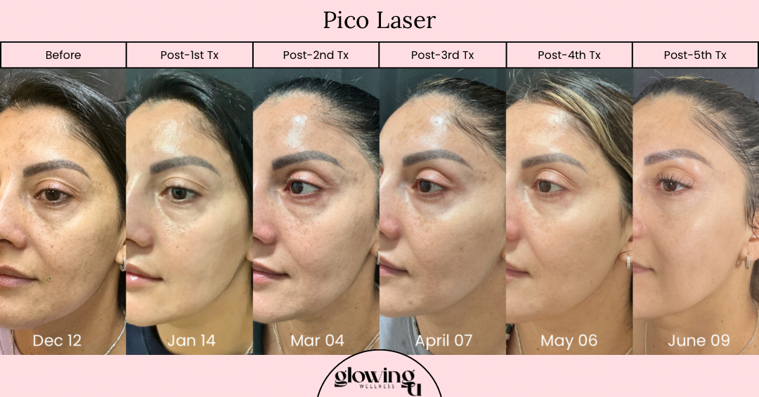 A side-by-side comparison of a woman's face showing skin improvements over time after Pico Laser treatments from December 12 to June 09, with labels for before and post-treatment dates.