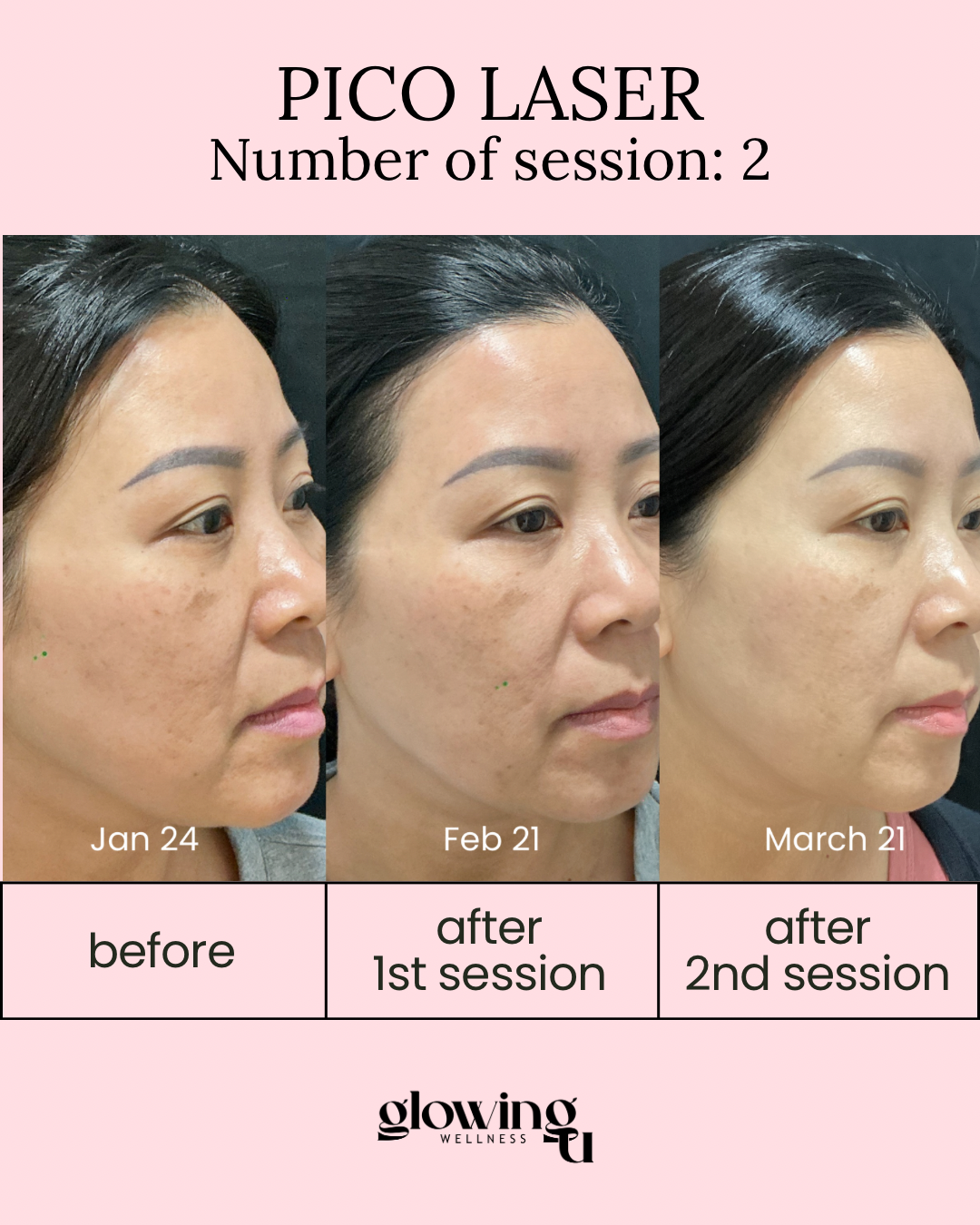 A side-by-side comparison of a woman's face before and after Pico Laser treatments over three months. The first image, dated January 24, shows her skin with hyperpigmentation and dark spots. The middle image, from February 21, displays some improvement with reduced pigmentation. The third image, from March 21, shows clearer, smoother skin with significantly fewer dark spots. The top text reads "Pico Laser, Number of session: 2," indicating she has undergone two laser sessions. The bottom section includes logos for 'glowing wellness'.
