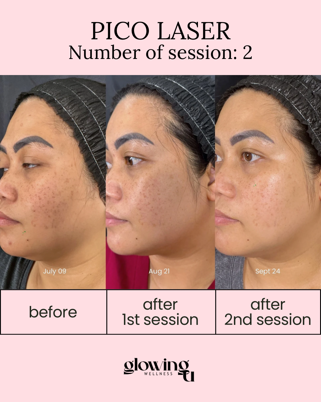 A skincare progress chart showing before and after images of a woman receiving Pico Laser treatments over three months. The images display noticeable reduction in facial hyperpigmentation, with dates July 9, August 21, and September 24 marked. The chart indicates the treatment was completed in two sessions at a wellness clinic.