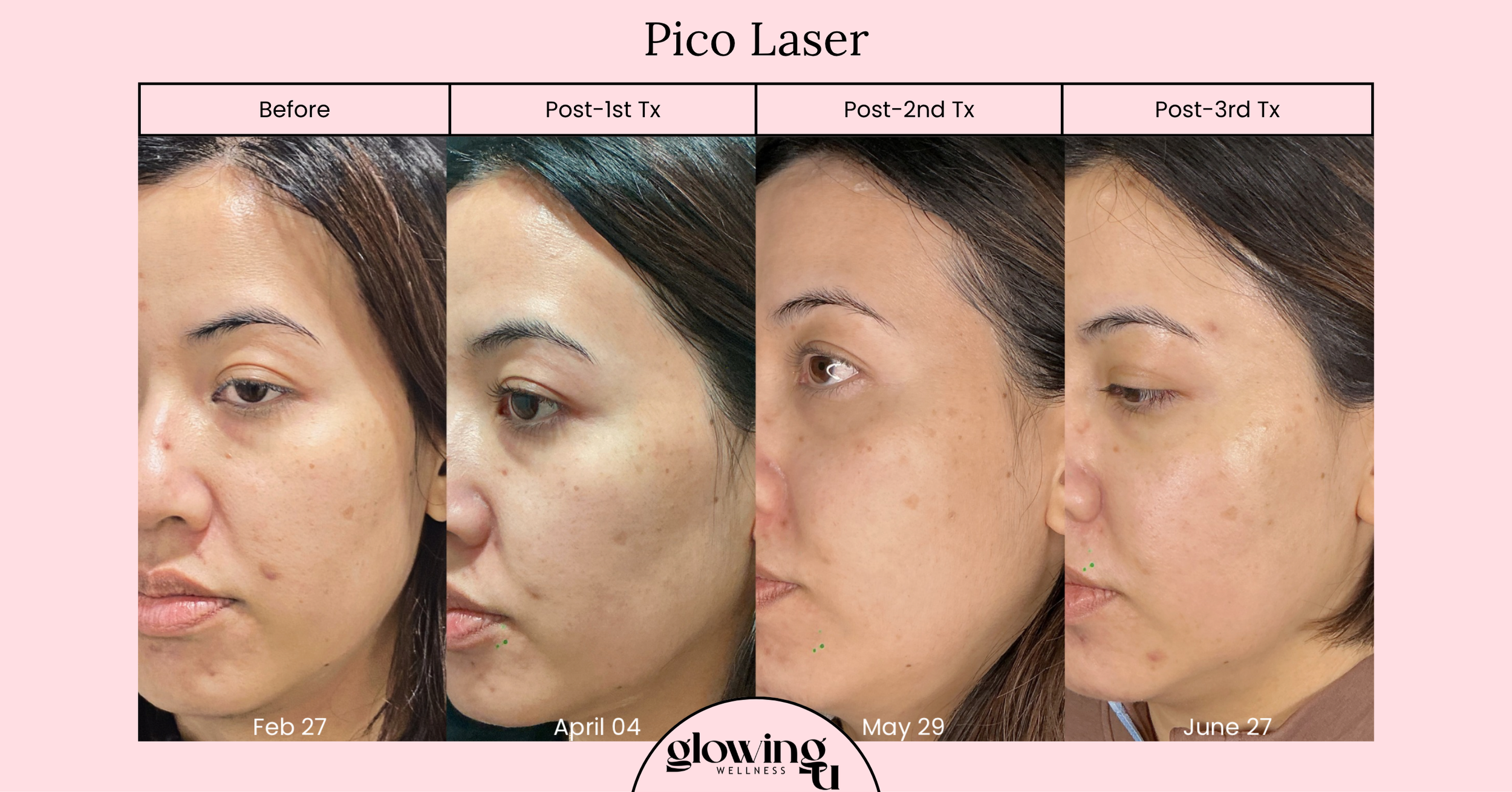 A side-by-side comparison of a woman's face showing skin improvement over four months through laser treatments, with photos dated February 27, April 4, May 29, and June 27, labeled as part of a skincare progress chart.