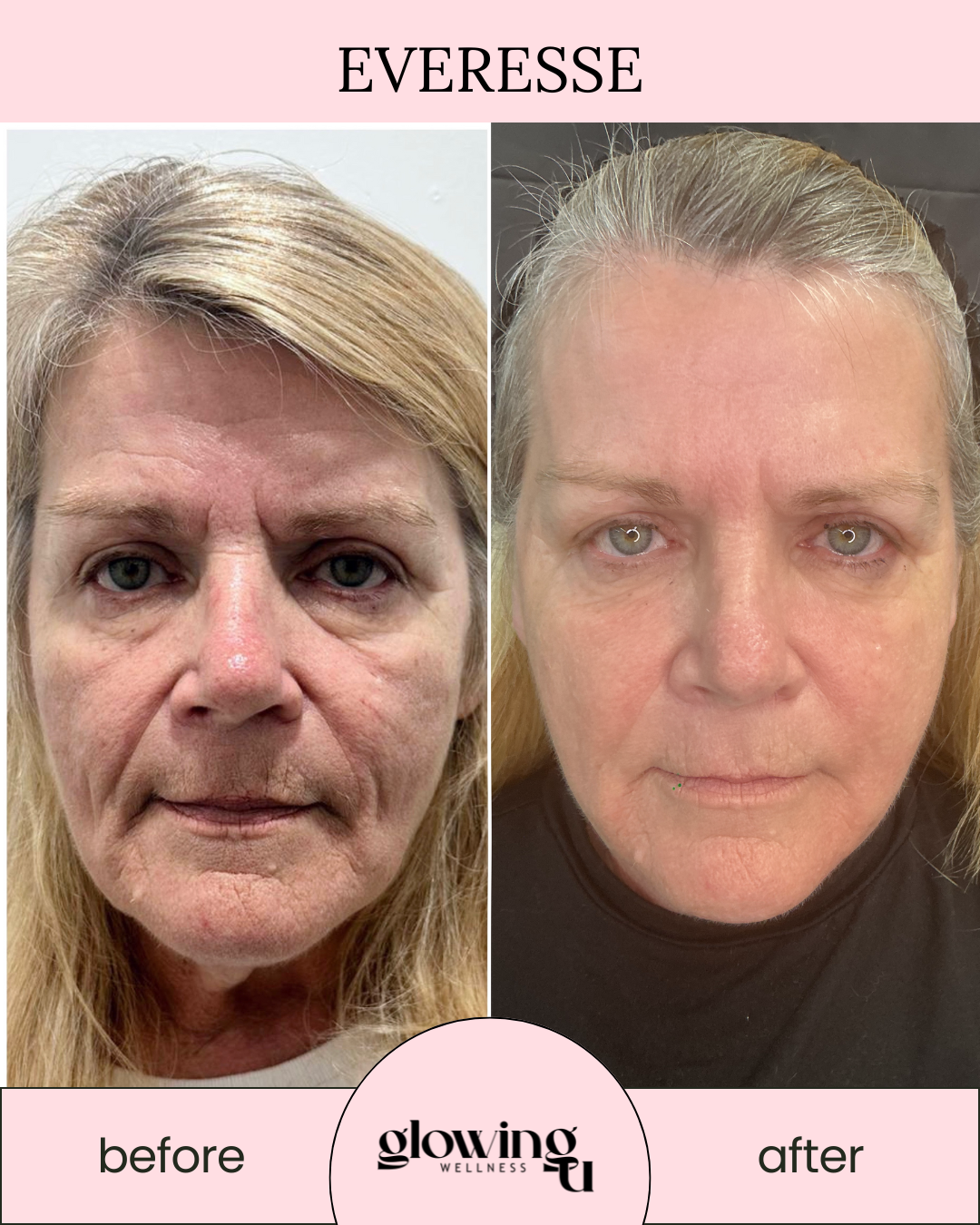 glowing u wellness - everesse-charlene.png