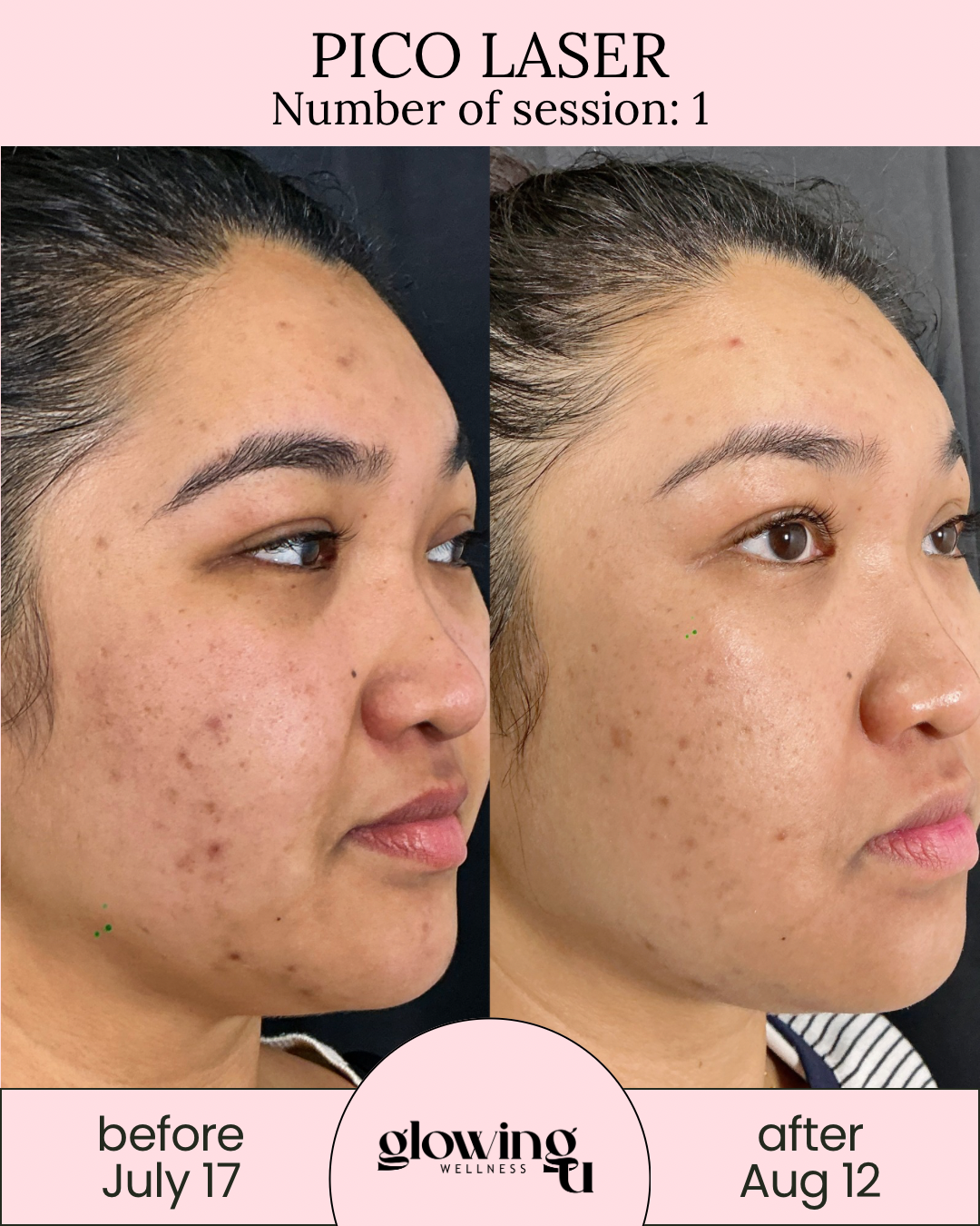 Side-by-side comparison of a woman's face showing skin improvement after Pico Laser treatment, with 'before' image dated July 17 and 'after' image dated August 12, highlighting reduced acne scars and hyperpigmentation.