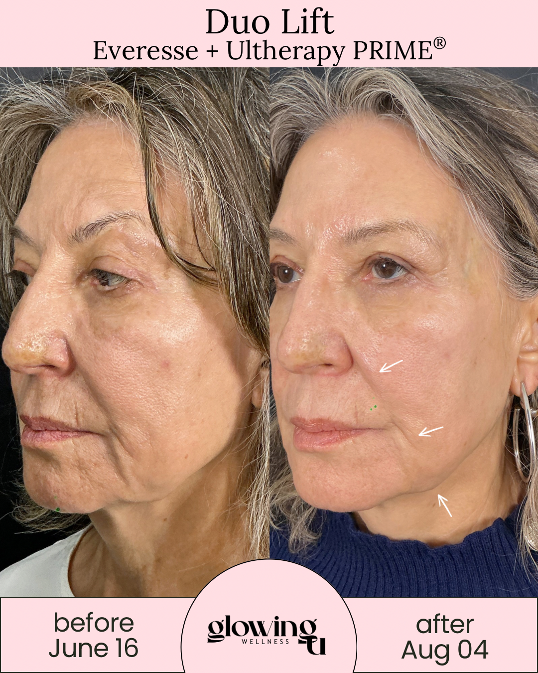 Side-by-side comparison of a woman's face before and after skincare treatment. The left image shows her face on June 16 with visible wrinkles and uneven skin tone. The right image, taken on August 4, shows smoother skin with fewer wrinkles, marked with white arrows and a green dot indicating areas of improvement. The treatment promoted is Duo Lift Everesse + Ultherapy PRIME by Glowing Wellness.