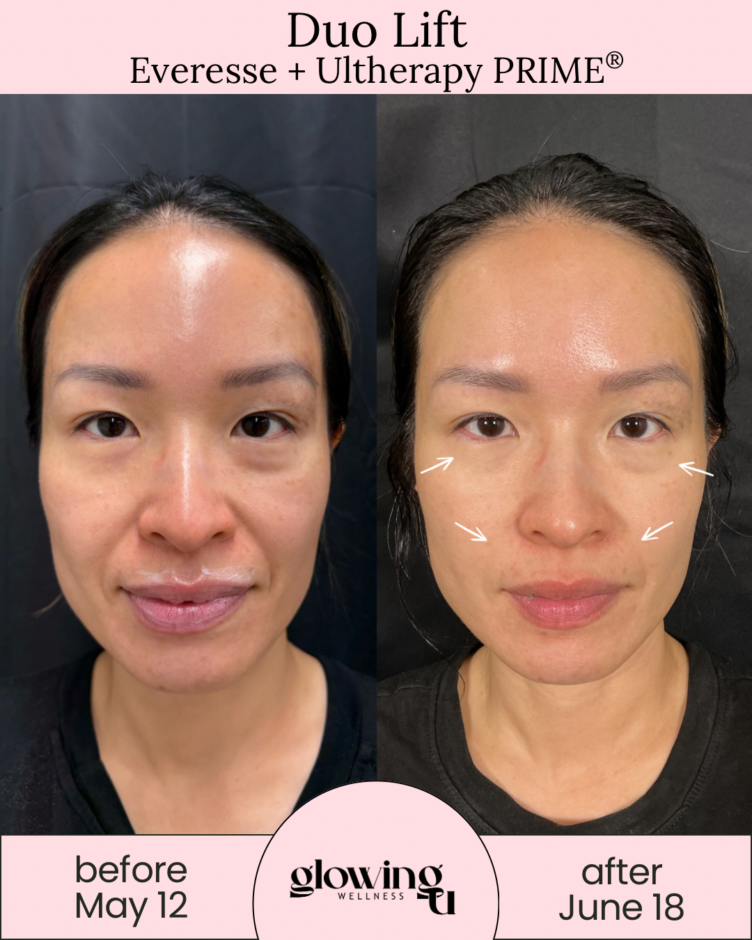 Before and after photos showing the results of Duo Lift treatment, with the before photo dated May 12 and the after photo dated June 18. The images highlight improvements in skin tightness and reduction of facial sagging.
