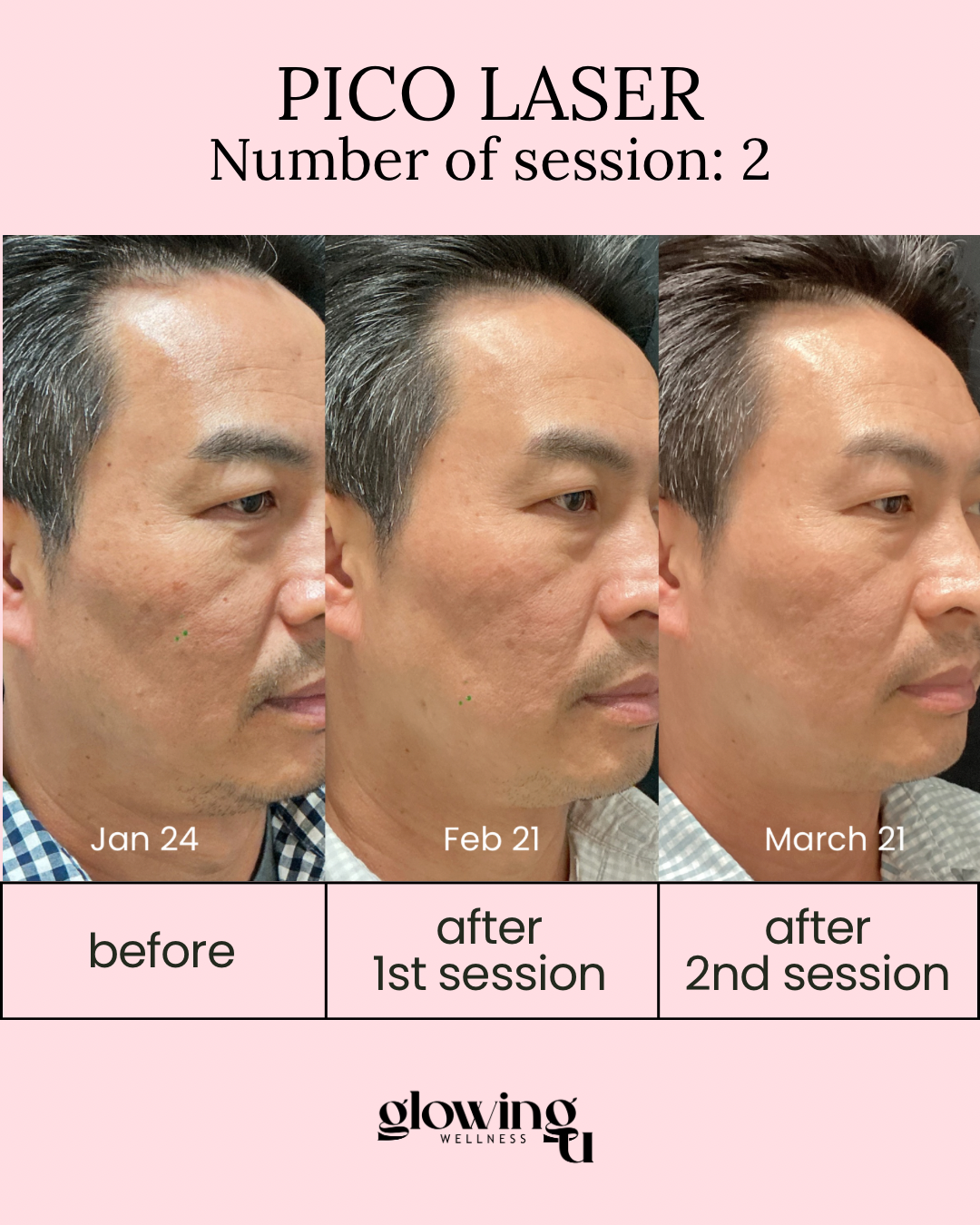 Progress photos of a man's facial skin before and after Pico Laser treatments. The first image is from January 24 showing skin with acne scars and blemishes. The second, from February 21, shows improvement with reduced scars. The third, from March 21, displays further skin improvement after the second session.
