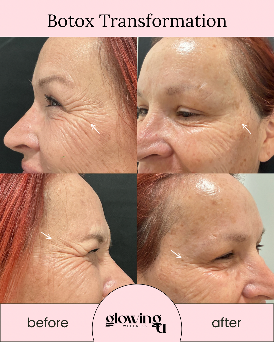 Comparison of a woman's face before and after Botox treatment showing reduced wrinkles on the forehead and around the eyes, labeled 'Botox Transformation' by Glowing Wellness.