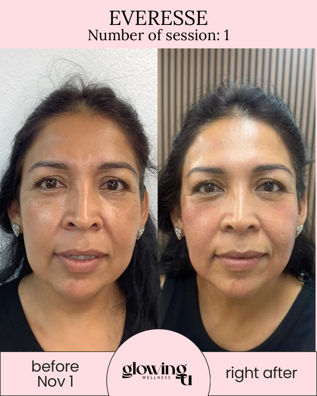 Side-by-side comparison of a woman's face, labeled 'before Nov 1' and 'right after,' showing improvements in skin brightness and texture after a wellness treatment.