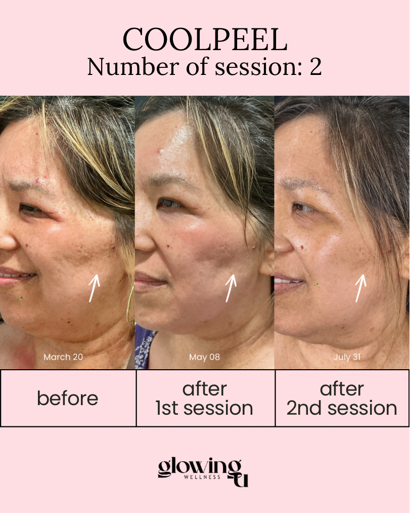 Progress photos of a woman showing skin improvement over three dates: March 20, May 8, and July 31, following two skincare sessions at Cool Peel. The photos display her side face with signs of skin condition changes. The image is branded with Glowing Wellness.