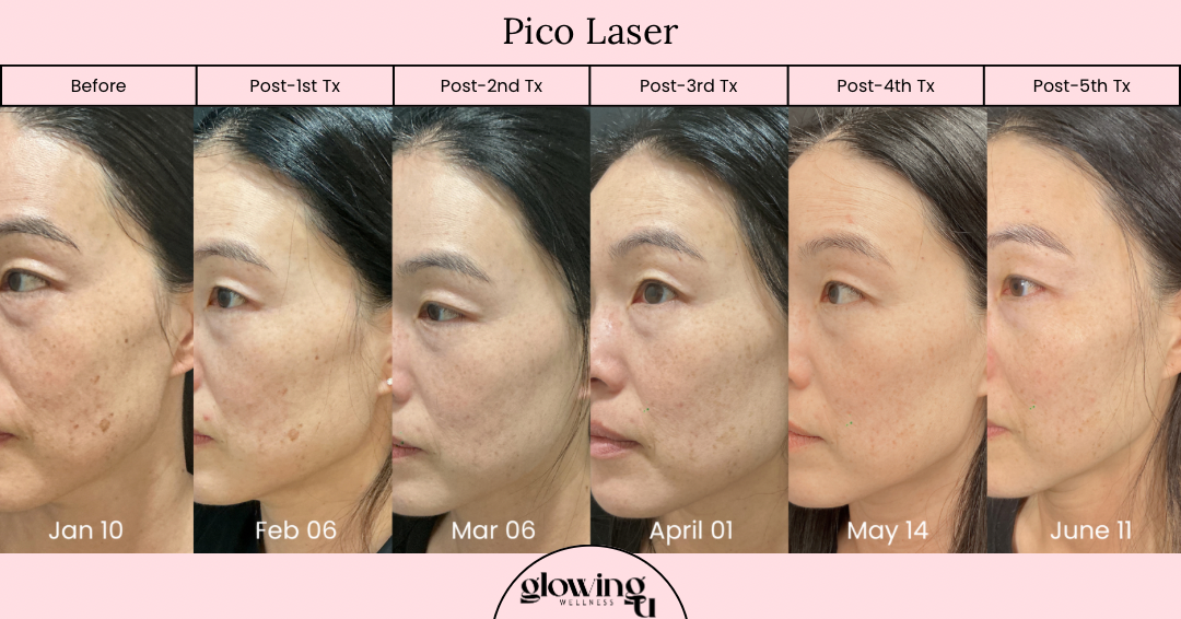 Progress photos of a woman's face over six months showing skin improvement from laser treatment, labeled 'Before' on January 10 and 'Post-5th Tx' on June 11, with dates and treatment stages noted above.
