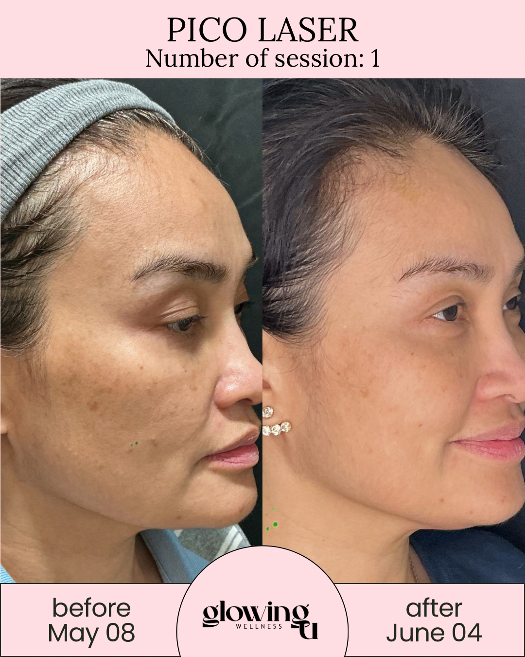 Side-by-side comparison of a woman's face before and after Pico Laser treatment, showing improvements in skin texture and pigmentation. The left image is labeled as before on May 8, and the right image is labeled as after on June 4, with branding for Glowing Wellness.