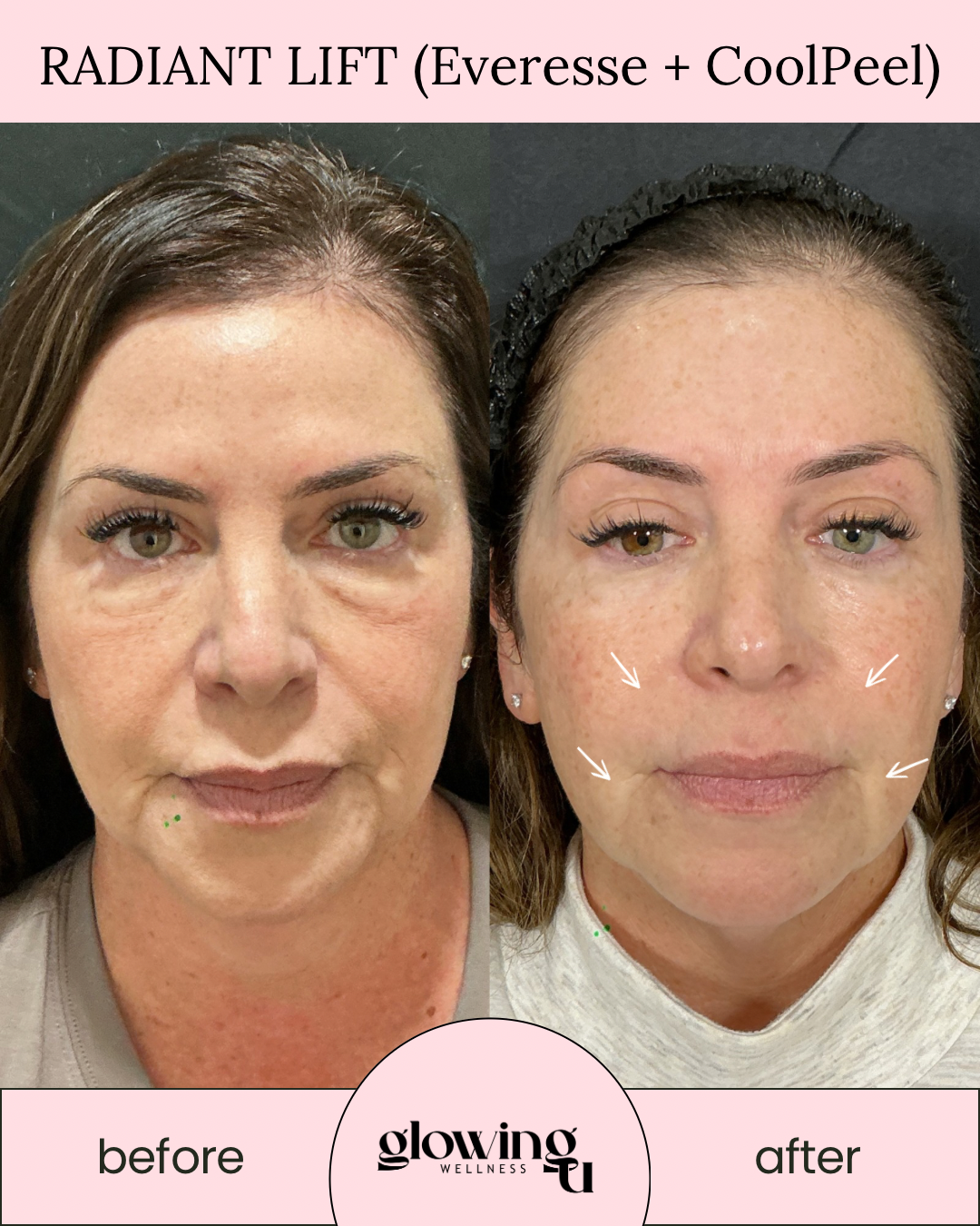 Before and after photos showing the effects of Radiant Lift treatment with Everesse and CoolPeel. The 'before' image shows a woman with visible signs of aging, including wrinkles and sagging skin. The 'after' image shows the same woman with smoother, firmer skin and reduced wrinkles, indicated by white arrows. The treatment is associated with the logo 'glowing Wellness' and labeled as a facial rejuvenation procedure.