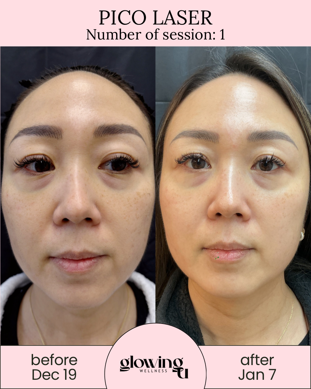 Side-by-side comparison of a woman's face before and after Pico Laser treatment, showing improved skin texture and reduced freckles. The left image is labeled 'before Dec 19,' and the right image is labeled 'after Jan 7.'