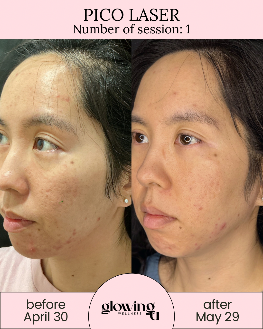 Side-by-side comparison of a woman's face before and after a Pico Laser treatment. The left side shows her skin with acne scars and blemishes as of April 30, and the right side shows improved skin with reduced scars as of May 29. The background is black on the left and dark on the right, with a pink overlay at the top and bottom of the image.