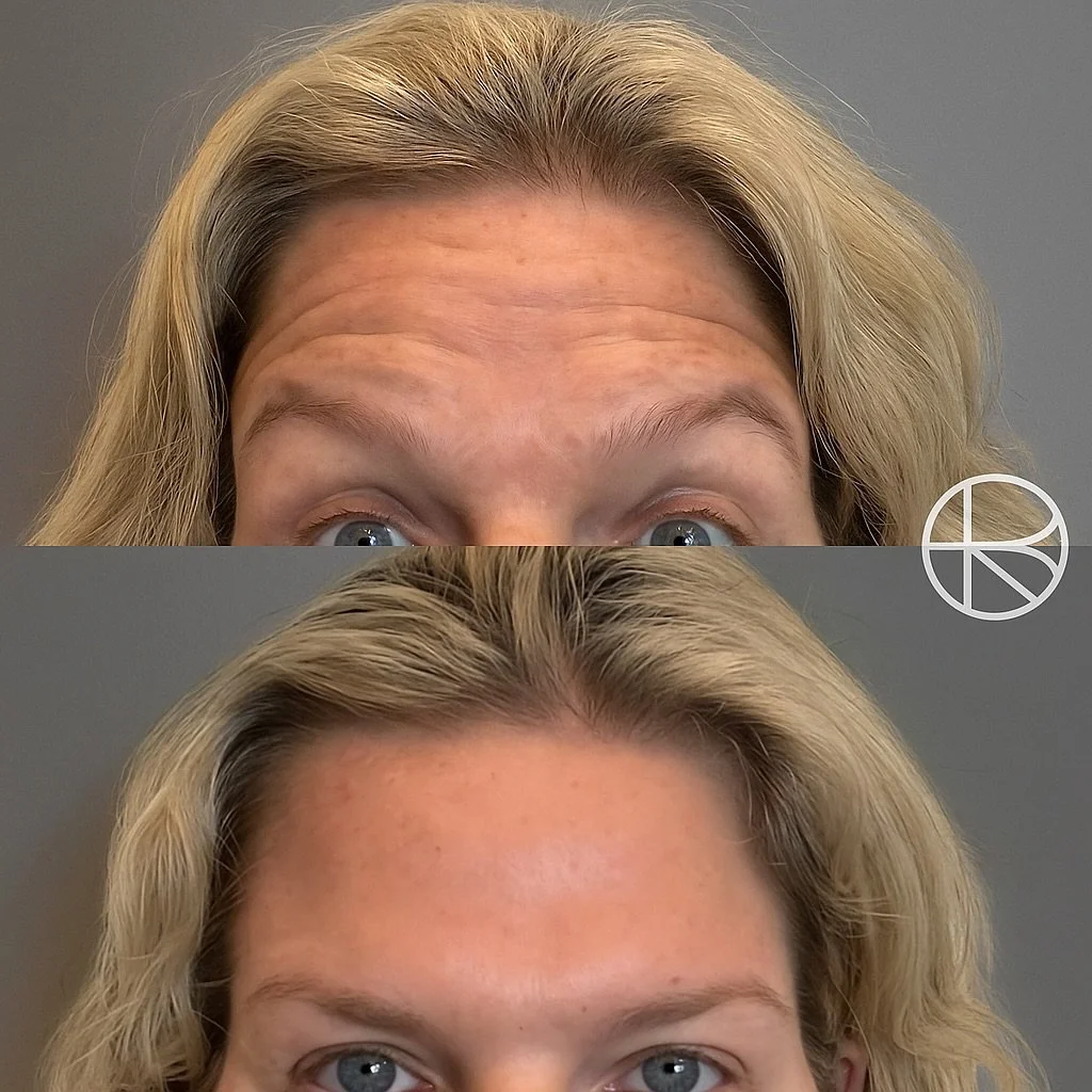 Enhanced By Ren provides a range of treatments that may help refresh the skin, soften visible signs of ageing, and restore facial balance. Before any procedure, a detailed consultation is carried out to understand your goals, determine suitability, a