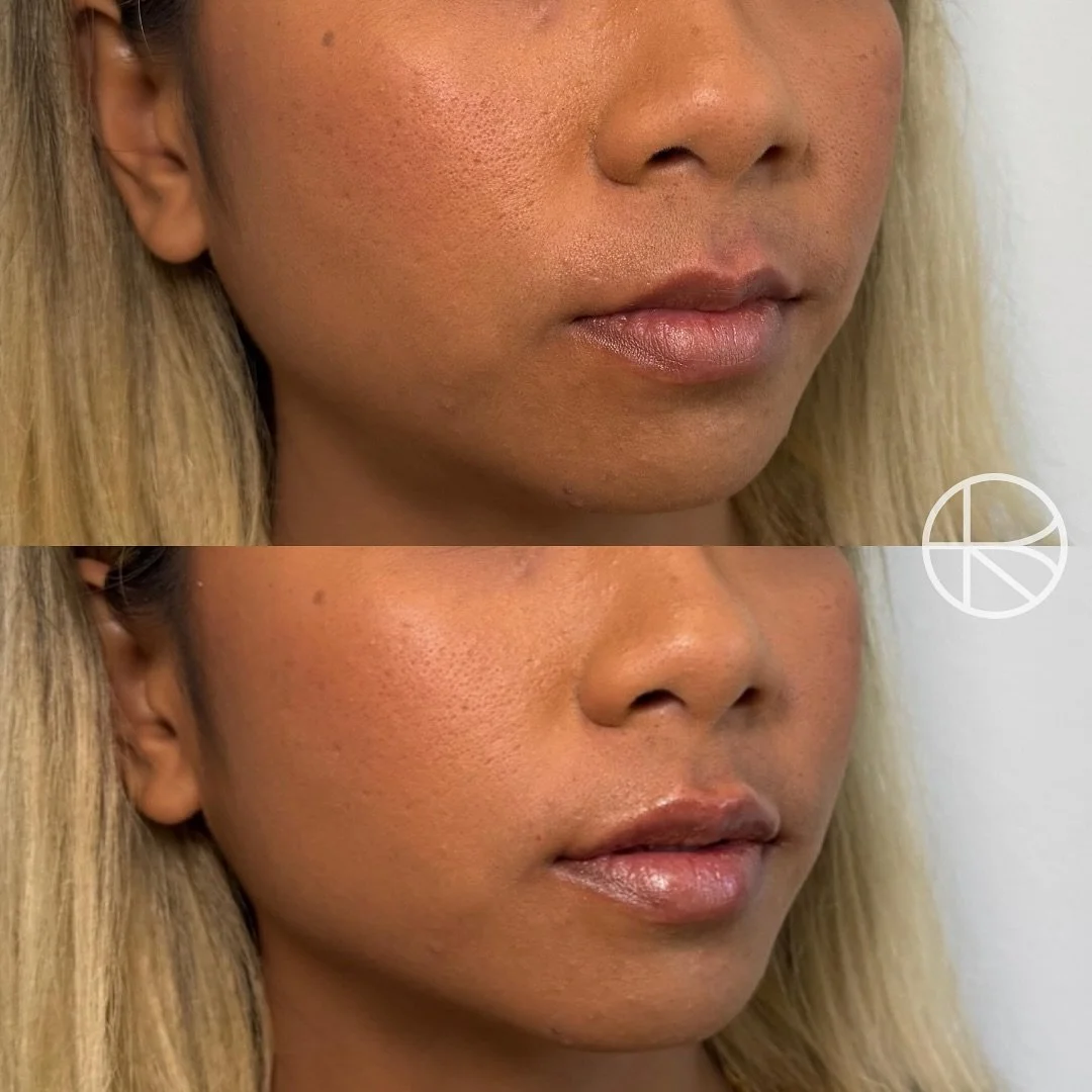 Enhanced By Ren provides a range of treatments that may help refresh the skin, soften visible signs of ageing, and restore facial balance. Before any procedure, a detailed consultation is carried out to understand your goals, determine suitability, a