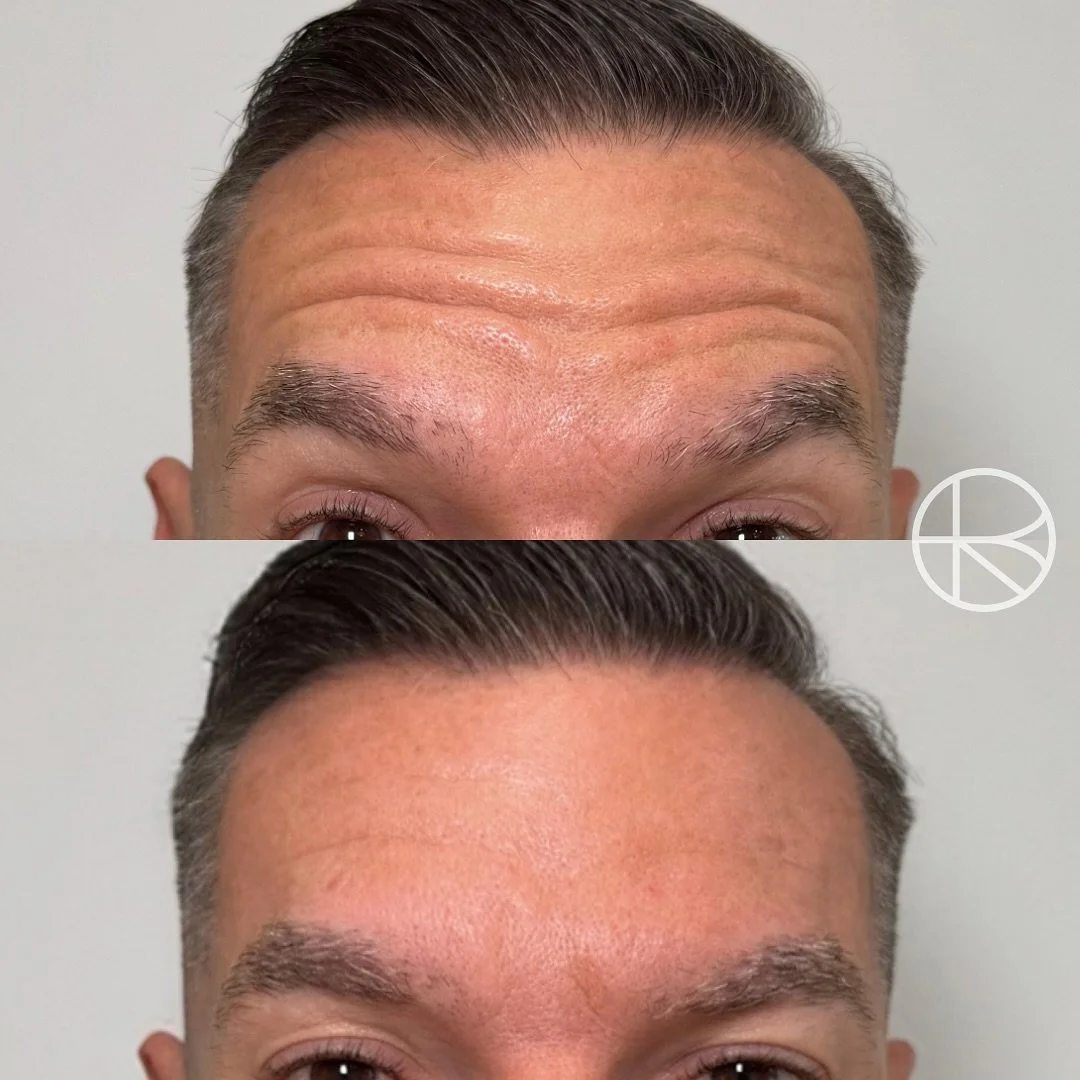 Enhanced By Ren provides a range of treatments that may help refresh the skin, soften visible signs of ageing, and restore facial balance. Before any procedure, a detailed consultation is carried out to understand your goals, determine suitability, a