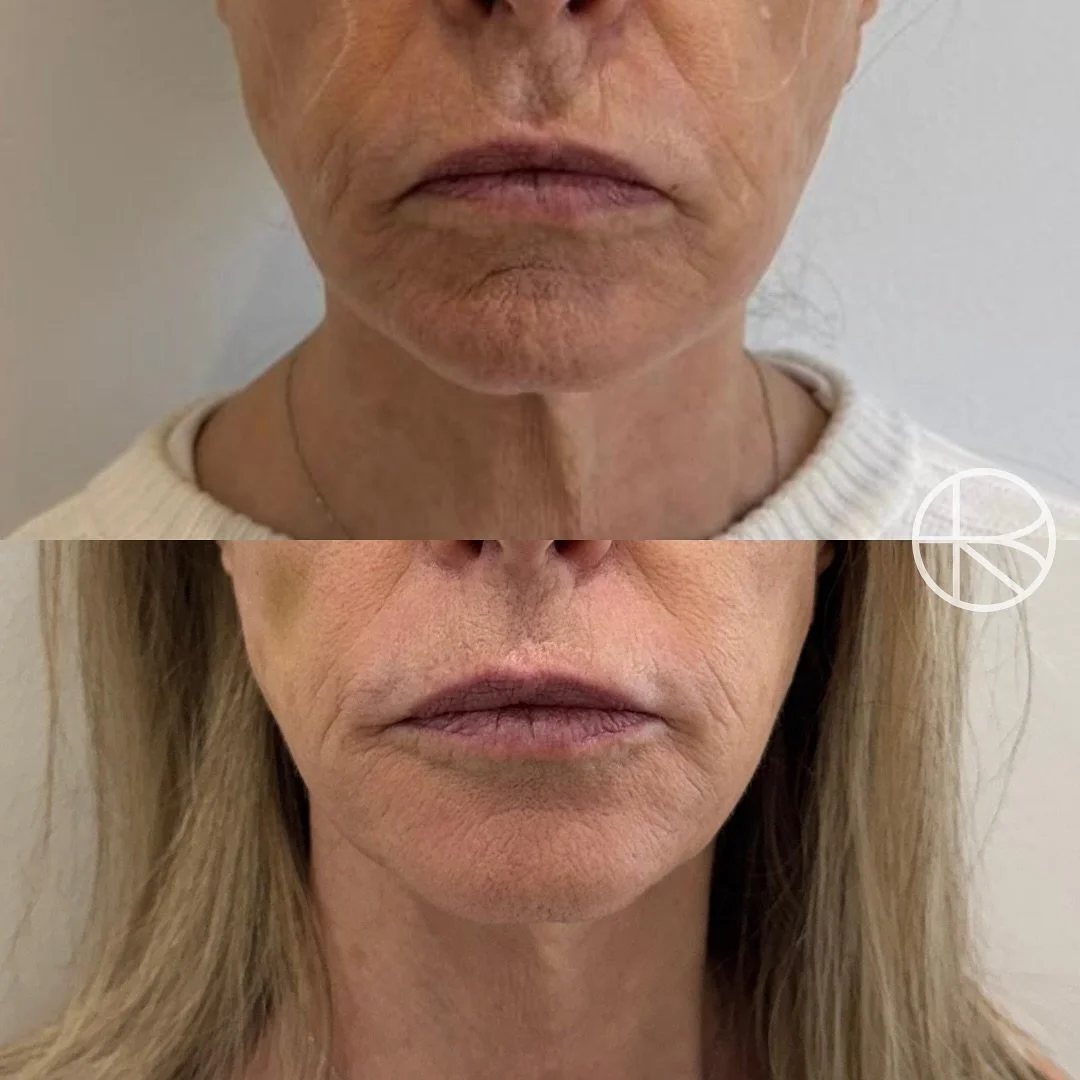 2 weeks post lower face rejuvenation treatment #renhanced #enhancedbyren #melbourne #aesthetics #rejuvenation 

Enhanced By Ren provides a range of treatments that may help refresh the skin, soften visible signs of ageing, and restore facial balance.
