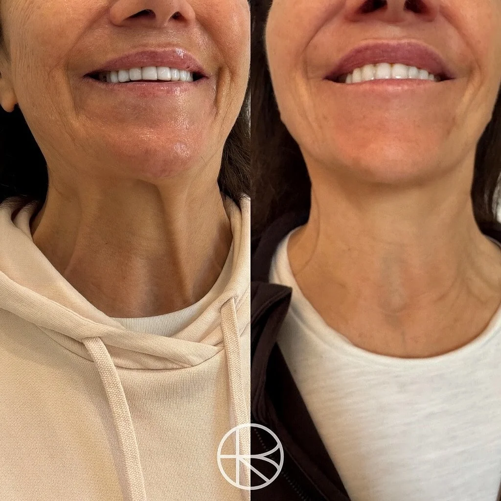 The Nefertiti Lift is a non surgical treatment designed to refine and lift the jawline, chin, and neck inspired by Queen Nefertiti&rsquo;s famously elegant profile.

By carefully relaxing specific muscles that pull the jawline downward (such as the p