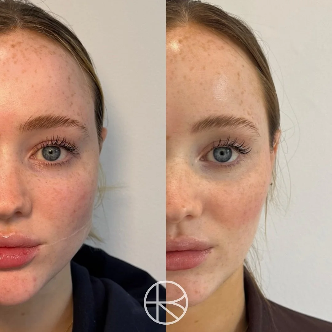 Many clients experience jaw tension, clenching, or headaches caused by overactive TMJ (masseter) muscles.
By carefully relaxing these muscles, we can help relieve discomfort and create a slimmer, more balanced jawline without altering your natural ex