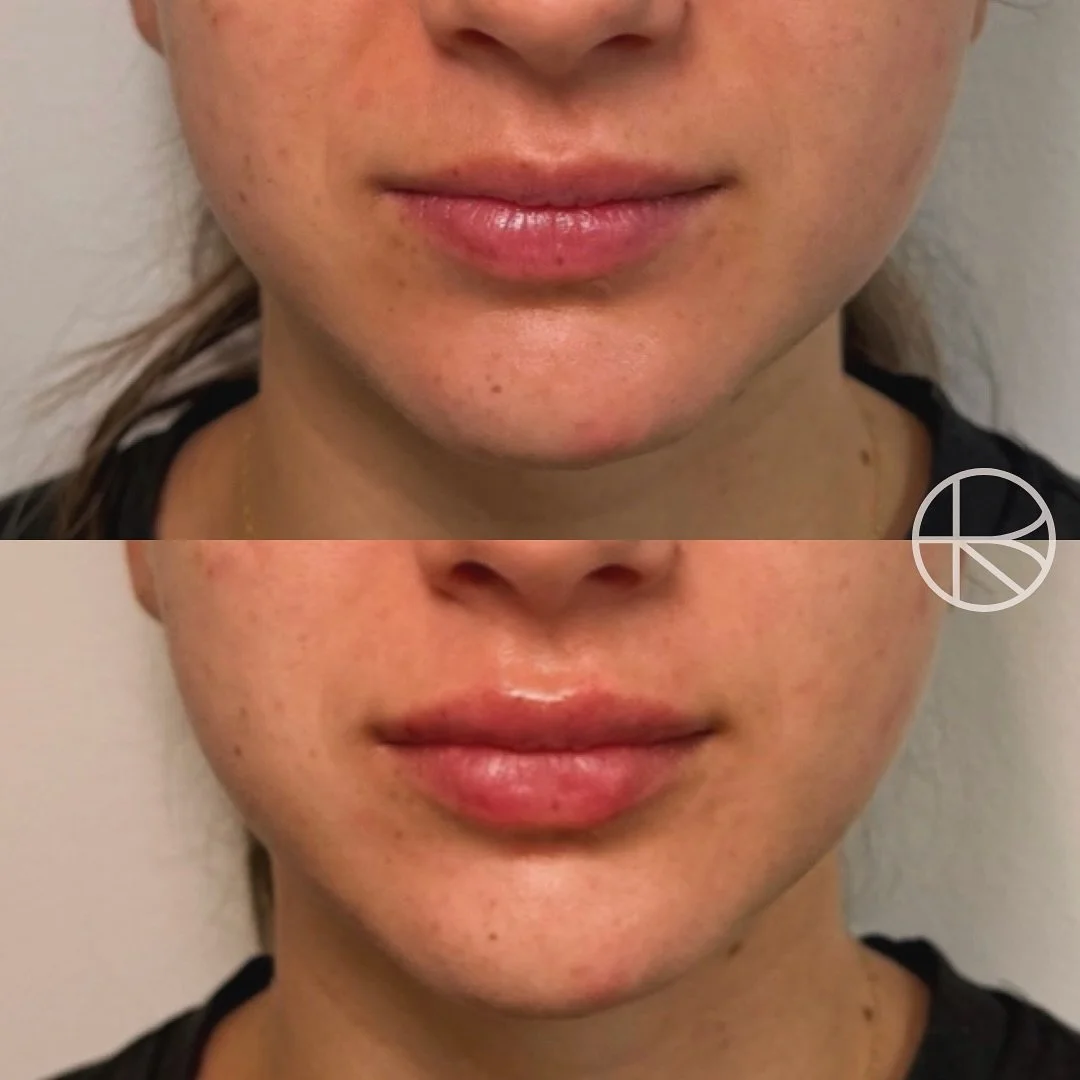 Enhanced By Ren provides a range of treatments that may help refresh the skin, soften visible signs of ageing, and restore facial balance. Before any procedure, a detailed consultation is carried out to understand your goals, determine suitability, a