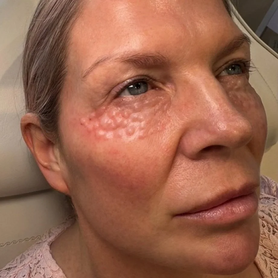 Rejuran under eye works beneath the surface to repair and restore the delicate under eye area, improving fine lines, crepiness, dark circles, and overall skin texture.

It stimulates collagen and elastin for smoother, stronger, more radiant skin over