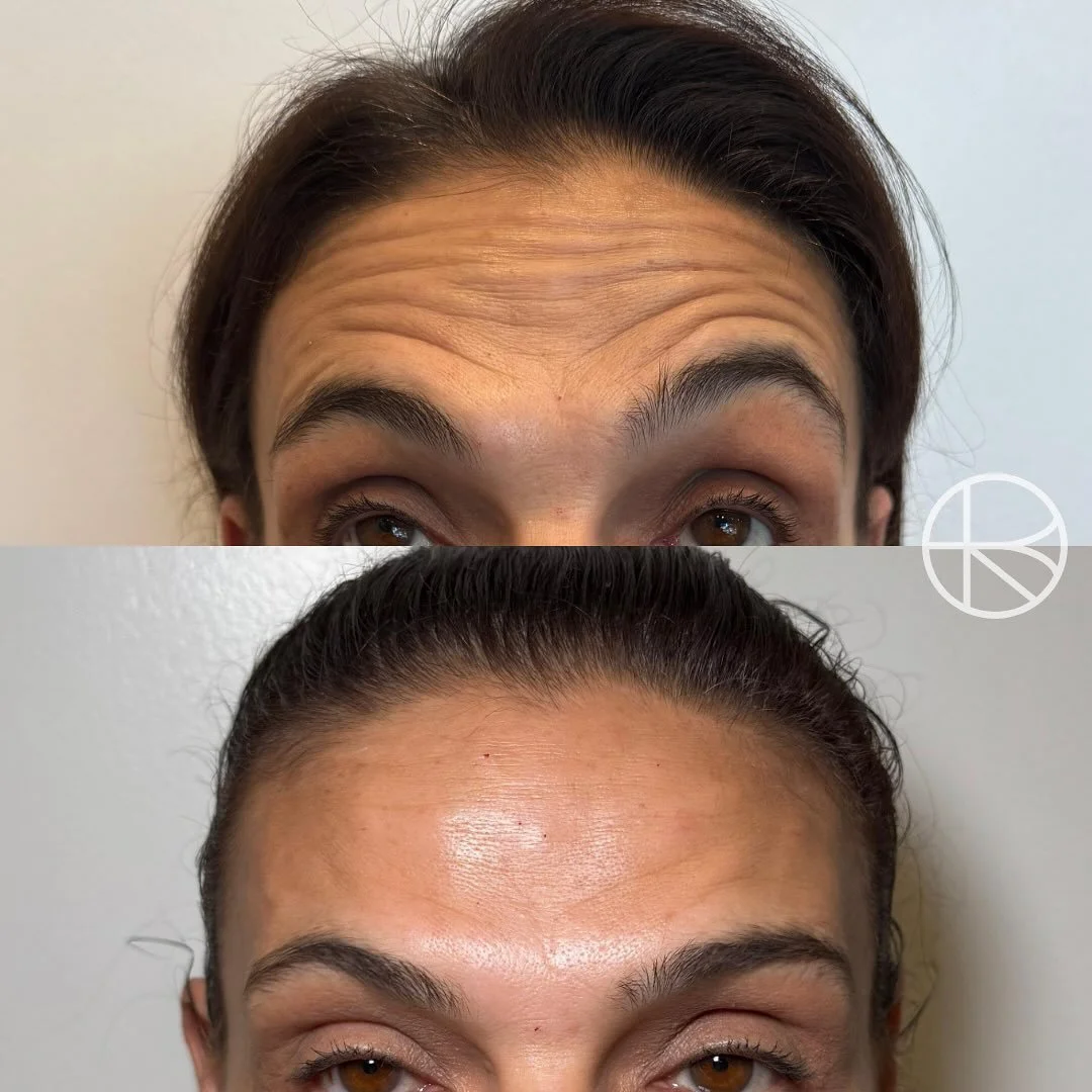2 weeks post treatment with Ren 

#renhanced #enhancedbyren #melbourne #aesthetic #beauty 

&ldquo;Enhanced By Ren provides a range of treatments that may help refresh the skin, soften visible signs of ageing, and restore facial balance. Before any p