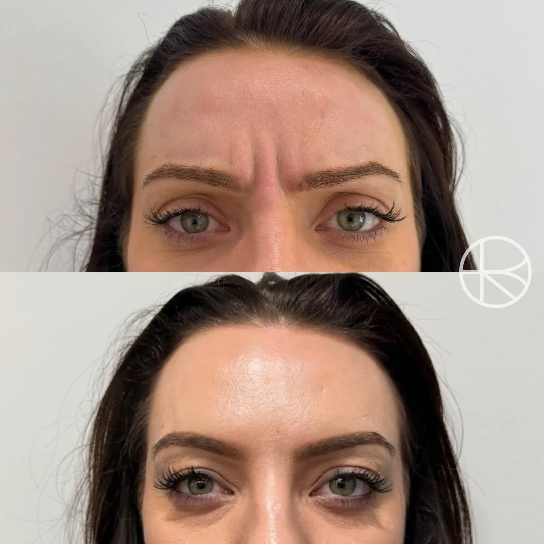 2 weeks post treatment #renhanced #enhancedbyren #melbourne #aesthetics 

&ldquo;Enhanced By Ren provides a range of treatments that may help refresh the skin, soften visible signs of ageing, and restore facial balance. Before any procedure, a detail