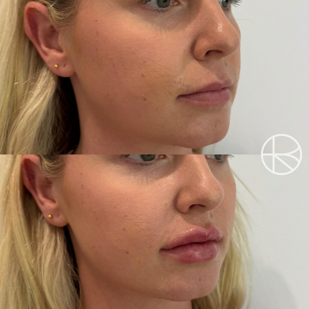 Volume enhancement treatment #renhanced #enhancedbyren #melbourne #beauty 

&ldquo;Enhanced By Ren provides a range of treatments that may help refresh the skin, soften visible signs of ageing, and restore facial balance. Before any procedure, a deta