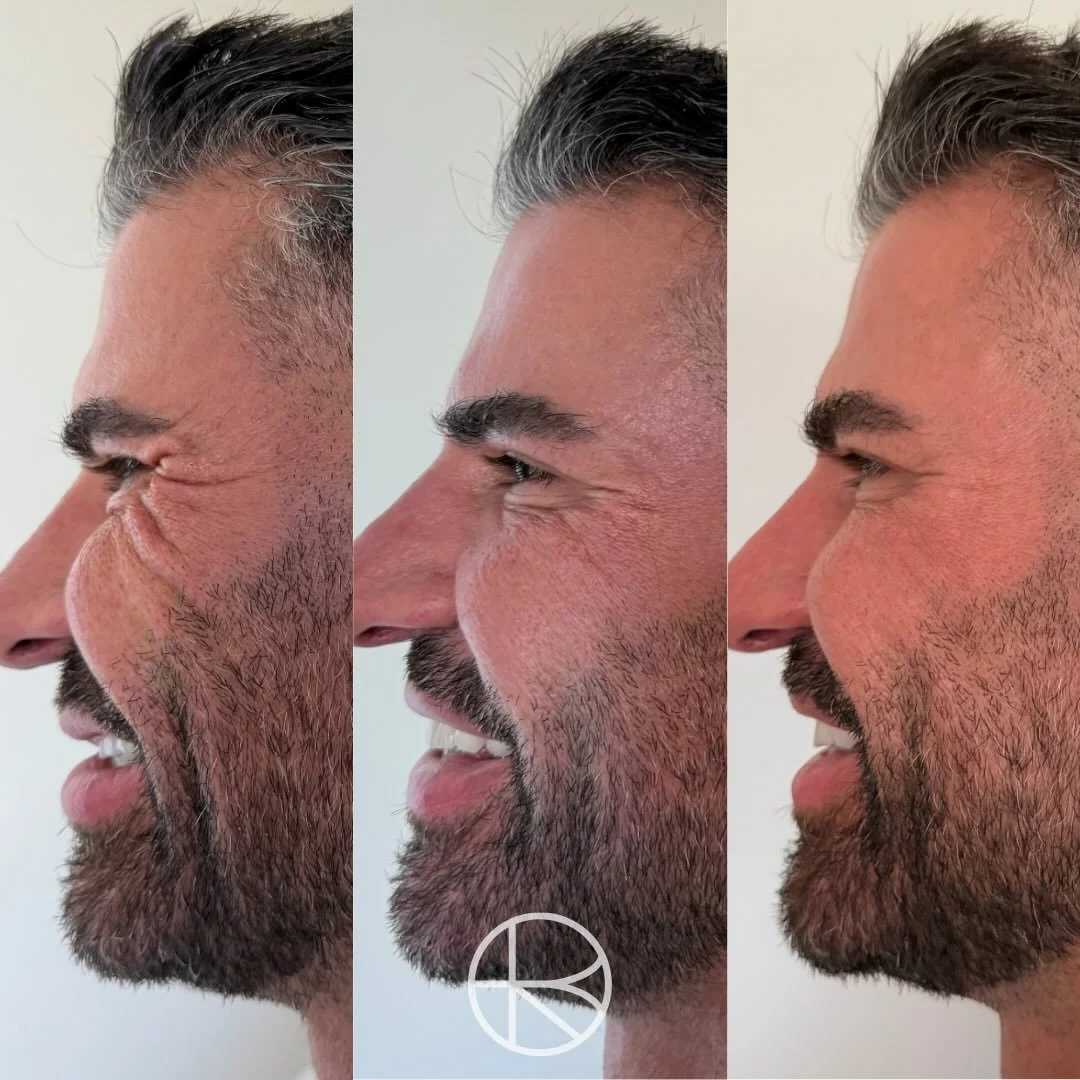 At Enhanced By Ren, we specialise in tailored wrinkle reduction treatments for both men and women, designed to soften lines while keeping results natural.

Male client on treatment day, week 1 and week 2 (final results.

Book a consultation for a ski