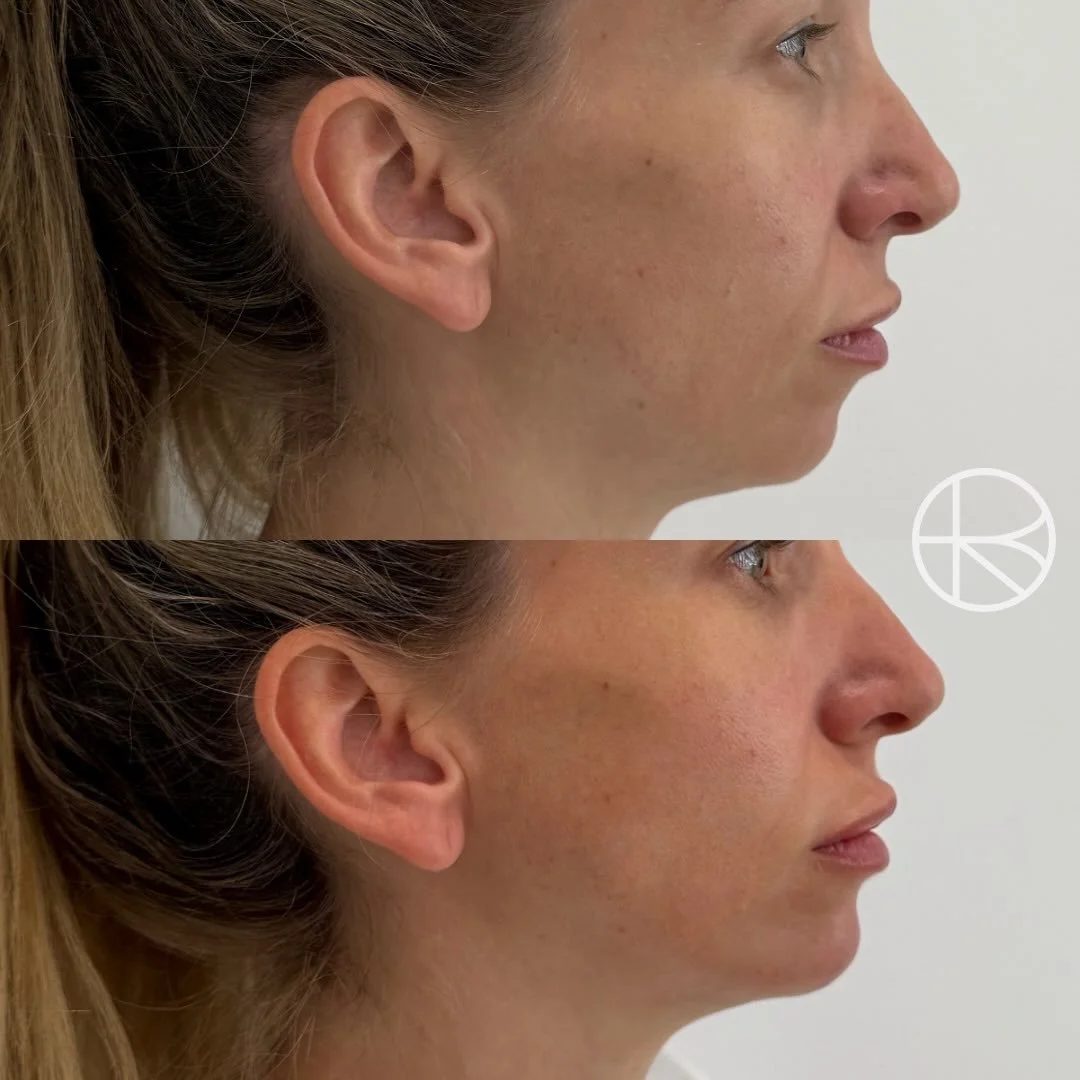 Volume enhancement to balance the profile #renhanced #enhancedbyren #melbourne #aesthetic

&ldquo;Enhanced By Ren provides a range of treatments that may help refresh the skin, soften visible signs of ageing, and restore facial balance. Before any pr