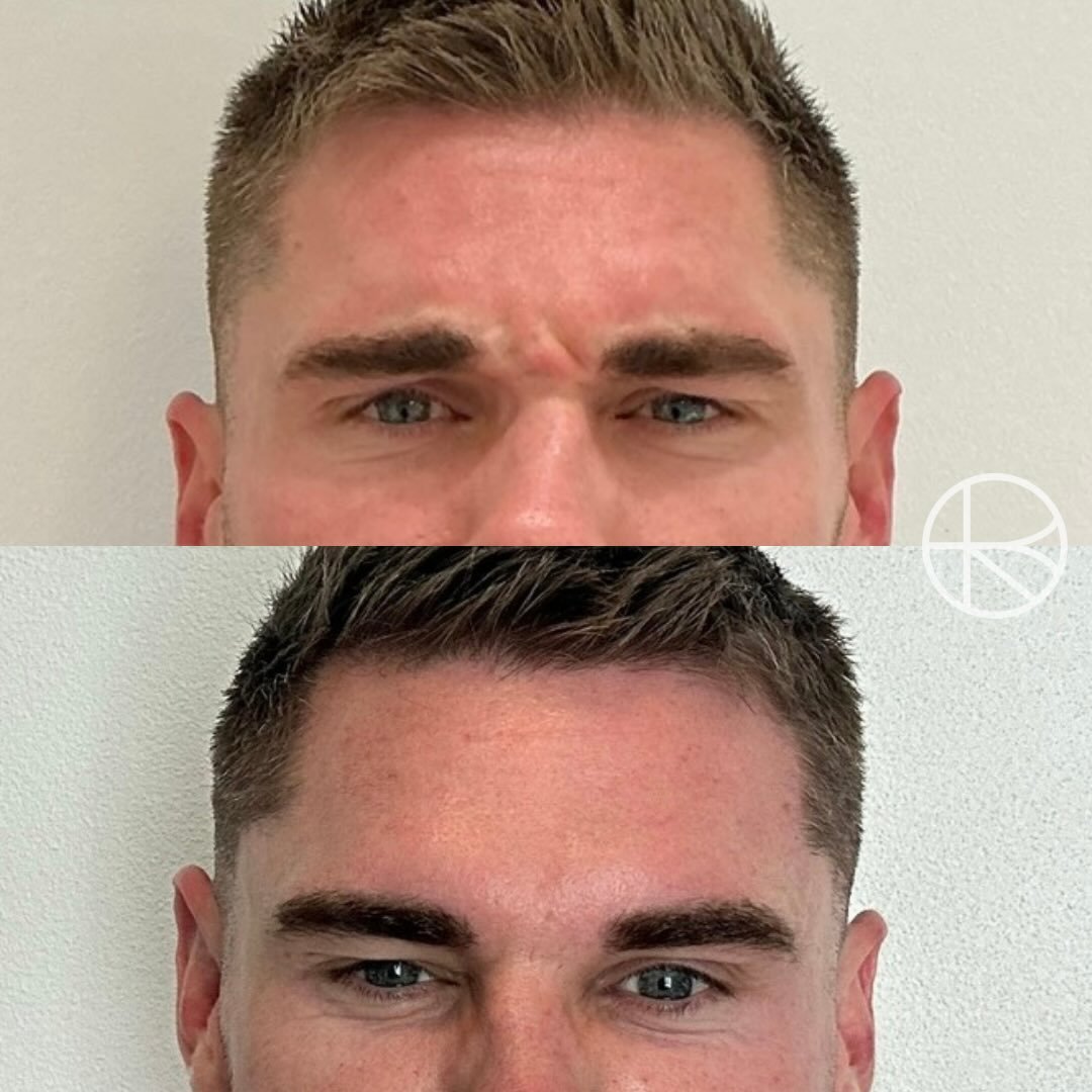 Wrinkle reduction treatment #renhanced #enhancedbyren #melbourne 

*Results vary between individuals. All cosmetic medical procedures carry risks and require consultation with a qualified health practitioner to determine suitability.