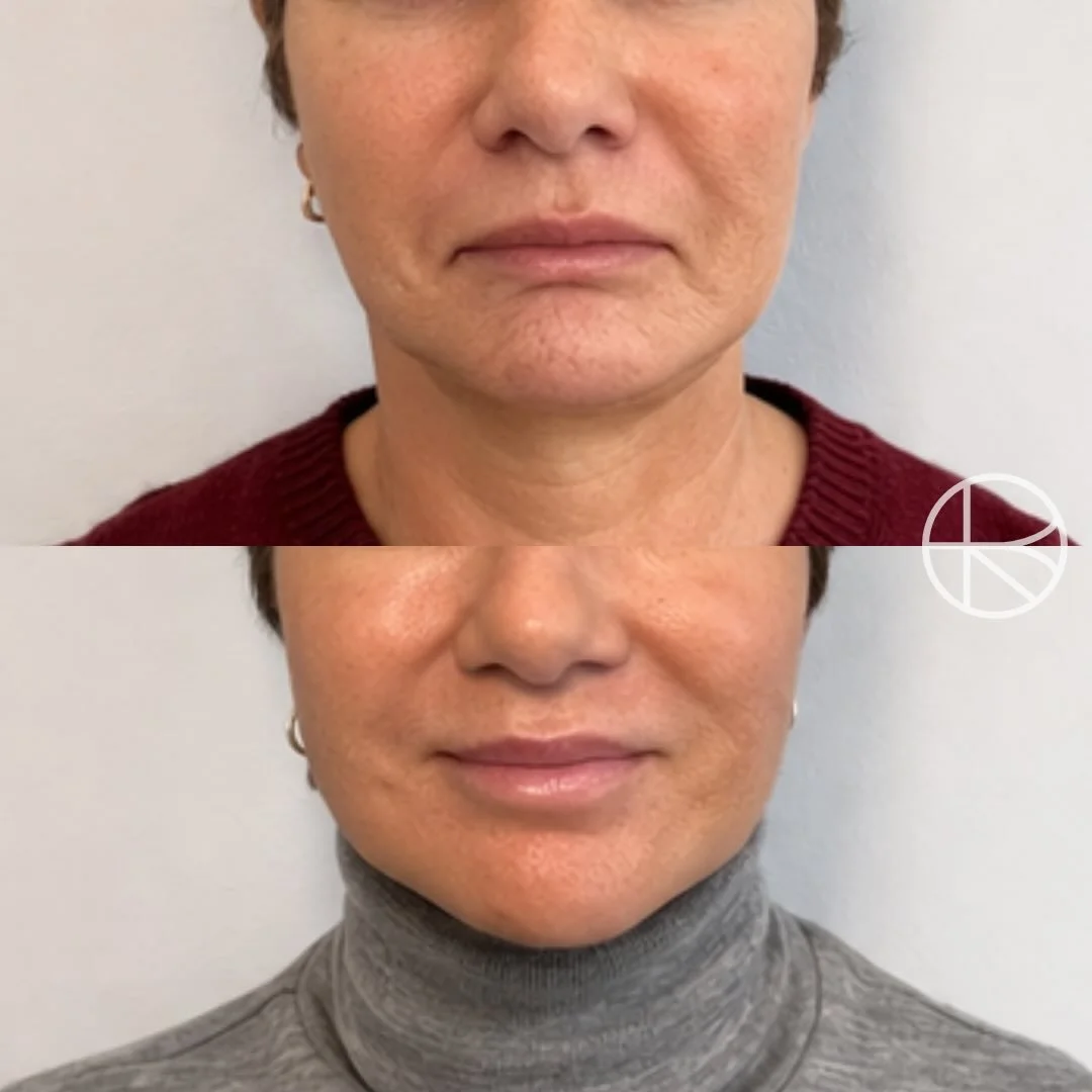With time, the lower face can develop a downward pull at the corners of the mouth.
A targeted approach can soften this and restore a more relaxed, uplifted expression. #renhanced #enhancedbyren #melbourne 

&ldquo;Results vary between individuals. Al