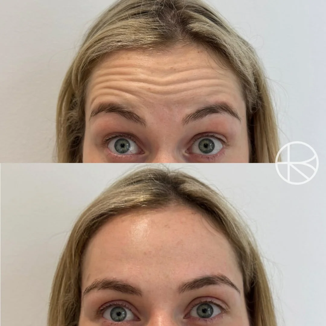 Enhanced By Ren provides treatments to help with wrinkles #renhanced #enhancedbyren #melbourne #aesthetics 

Disclaimer 

Results vary between individuals. All cosmetic medical procedures carry risks and require consultation with a qualified health p
