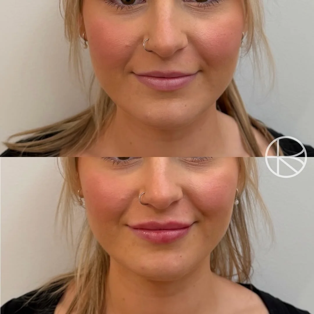 Subtle enhancements #renhanced #enhancedbyren #aesthetic #melbourne 

Disclaimer 

Results vary between individuals. All cosmetic medical procedures carry risks and require consultation with a qualified health practitioner to determine suitability.