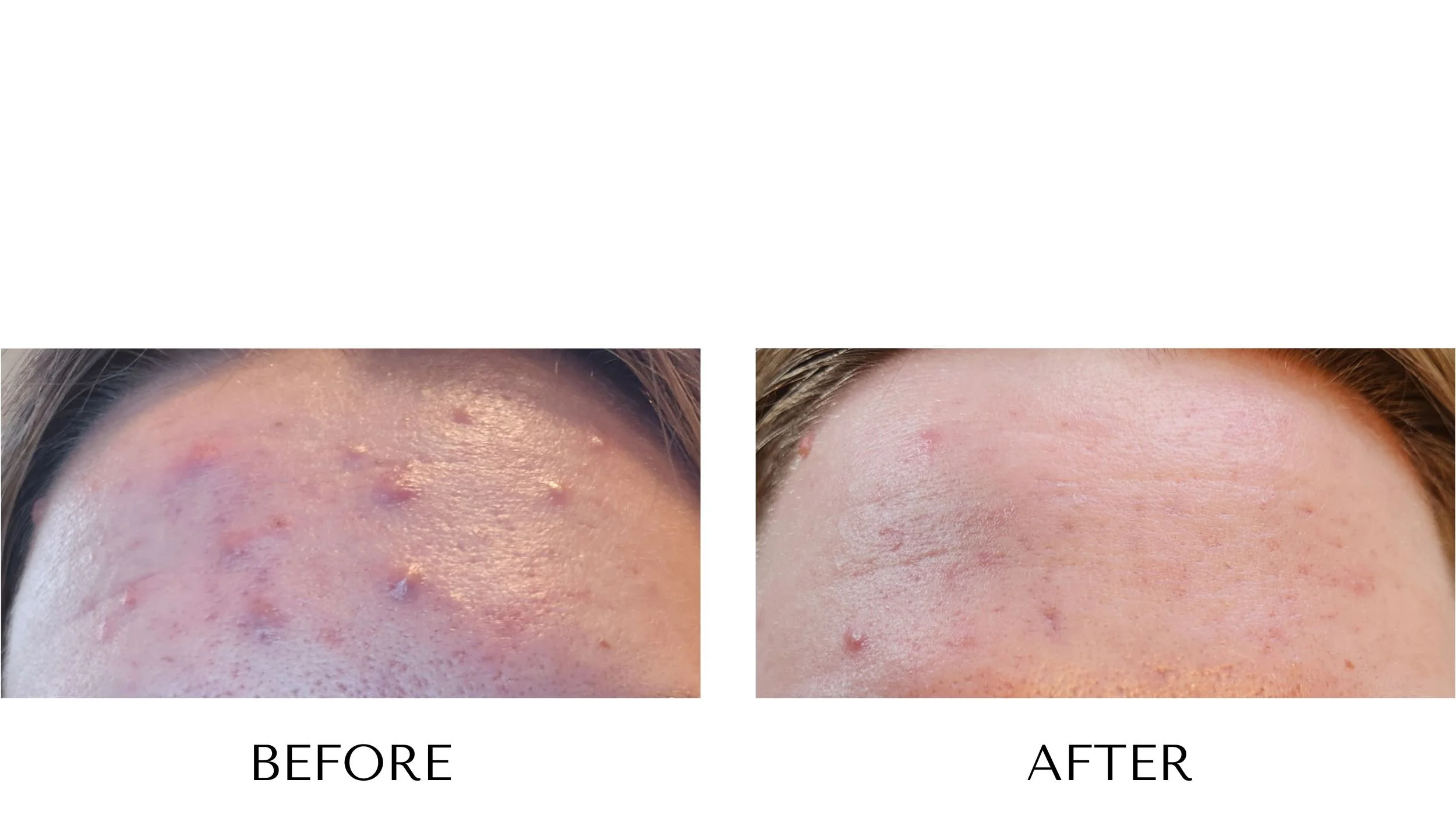 Before and after laser acne treatment at NUYU Laser & Skin Rejuvenation in Belleville, Ontario, showing clearer, smoother skin and reduced acne for moderate/severe acne, clogged pores, inflammation, and PIH (post-inflammatory hyperpigmentation).