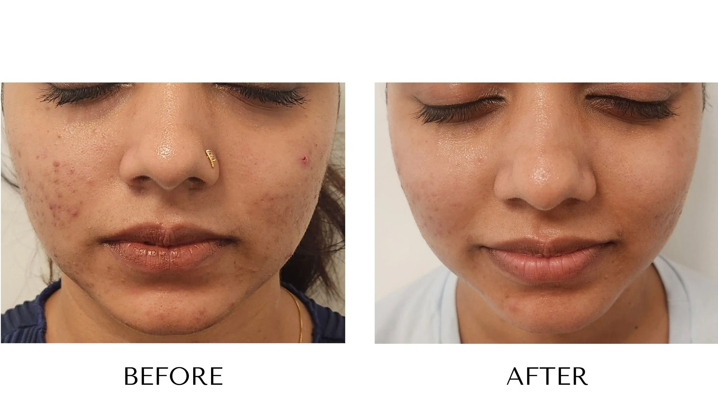 Before and after ProCell Microchanneling at NUYU Laser & Skin Rejuvenation in Belleville, Ontario, showing reduced acne scars and PIH (Post-Inflammatory Hyperpigmentation).