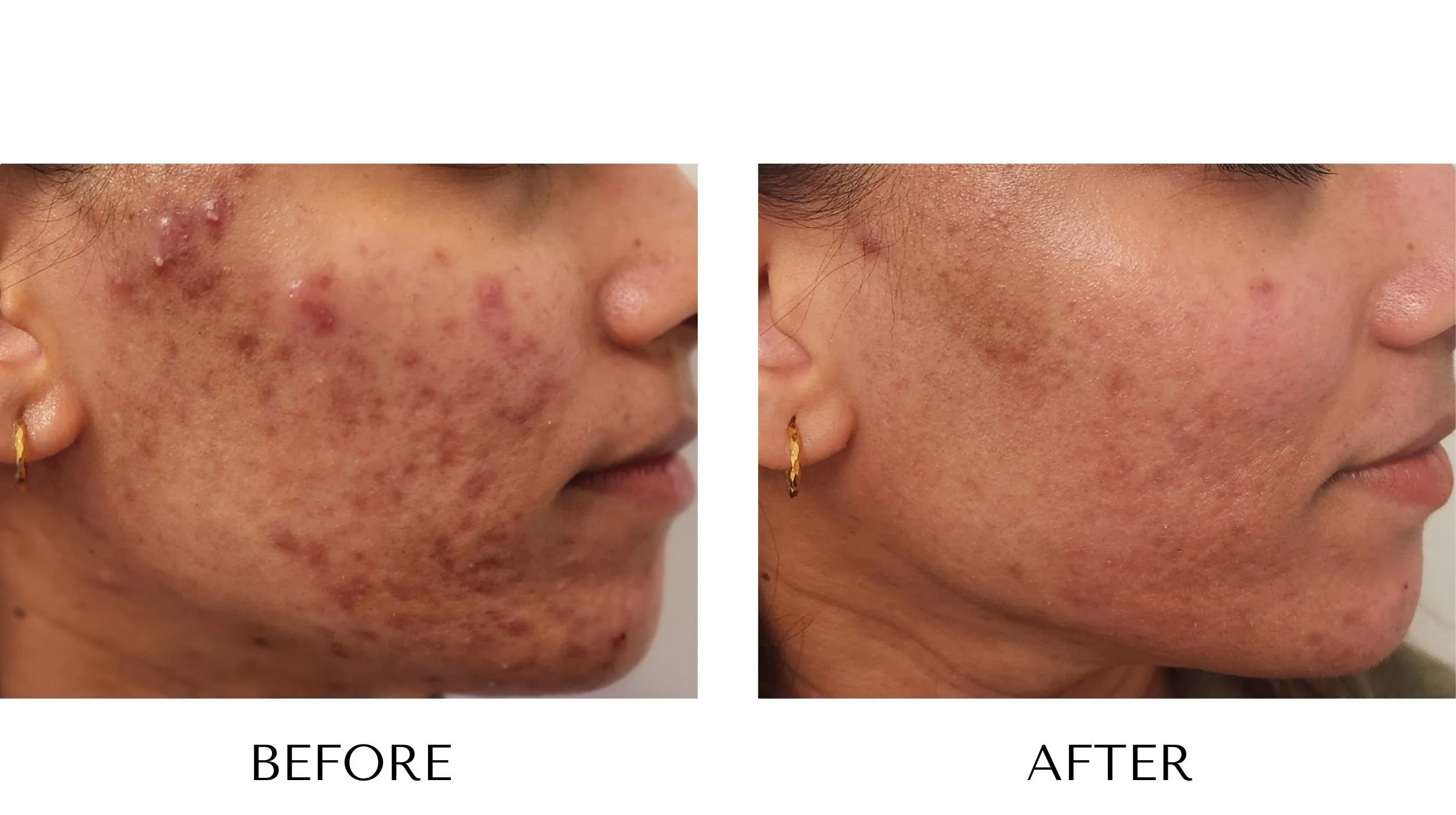 Before and after laser acne treatment at NUYU Laser & Skin Rejuvenation in Belleville, Ontario, showing clearer, smoother skin and reduced acne for moderate/severe acne, clogged pores, inflammation, and PIH (post-inflammatory hyperpigmentation).