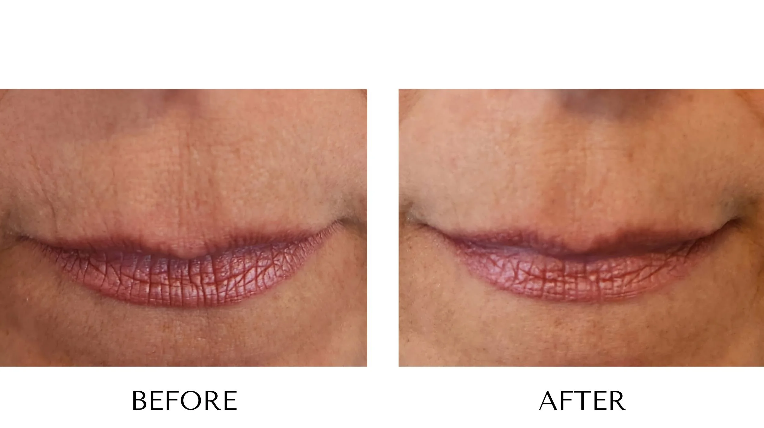 NUYU-laser-skin-rejuvenation-procell-microchanneling-upper-lip-wrinkles-results-1.jpg