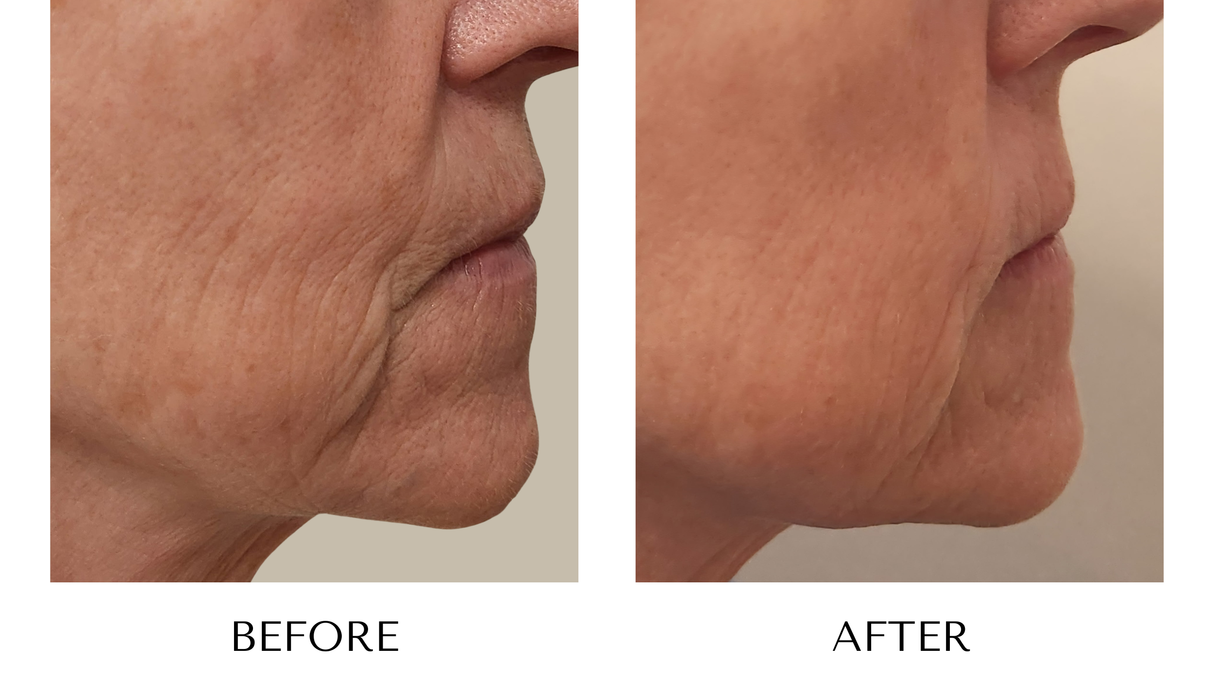Before and after photos of the P & P Duo Treatment at NUYU Laser & Skin Rejuvenation in Belleville, Ontario, targeting jowls, and skin texture for a youthful glow.