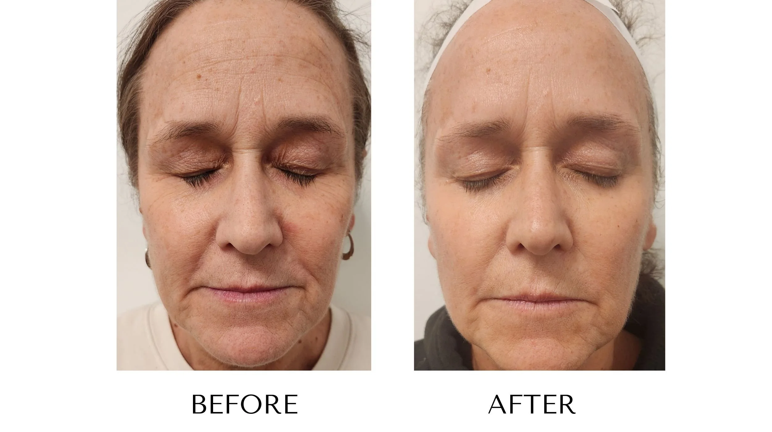 NUYU-laser-skin-rejuvenation-ipl-photofacial-results-9.jpg
