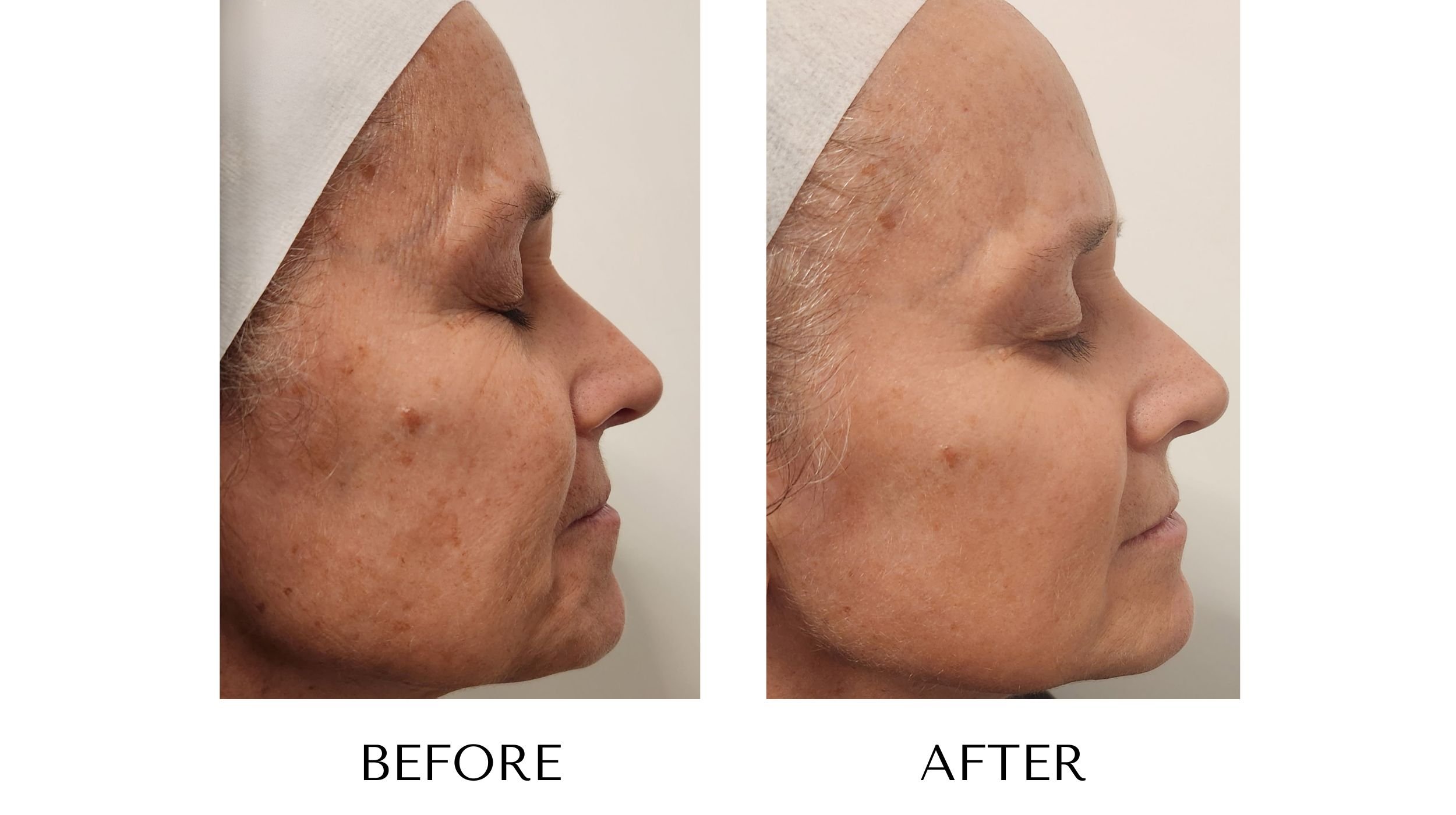 NUYU-laser-skin-rejuvenation-ipl-photofacial-results-11.jpg