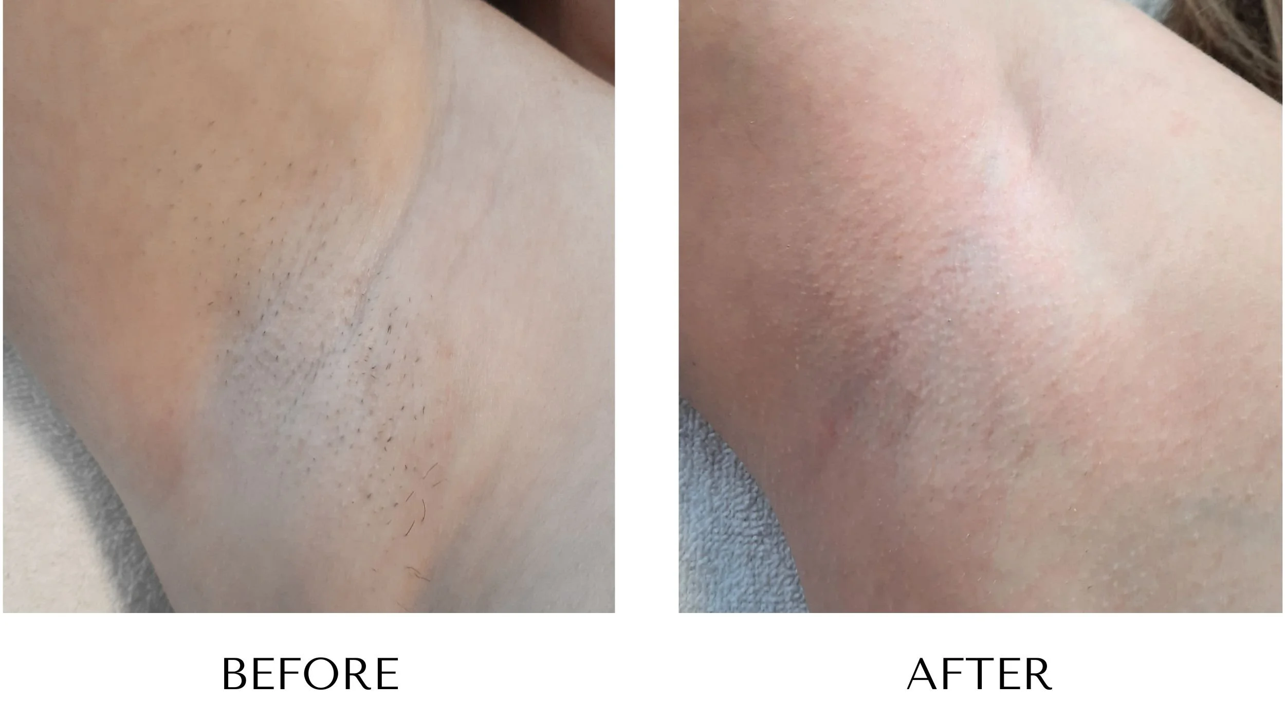 Before and after photos of women’s underarms laser hair removal at NUYU Laser & Skin Rejuvenation in Belleville, Ontario, showing reduced hair growth and smoother skin.