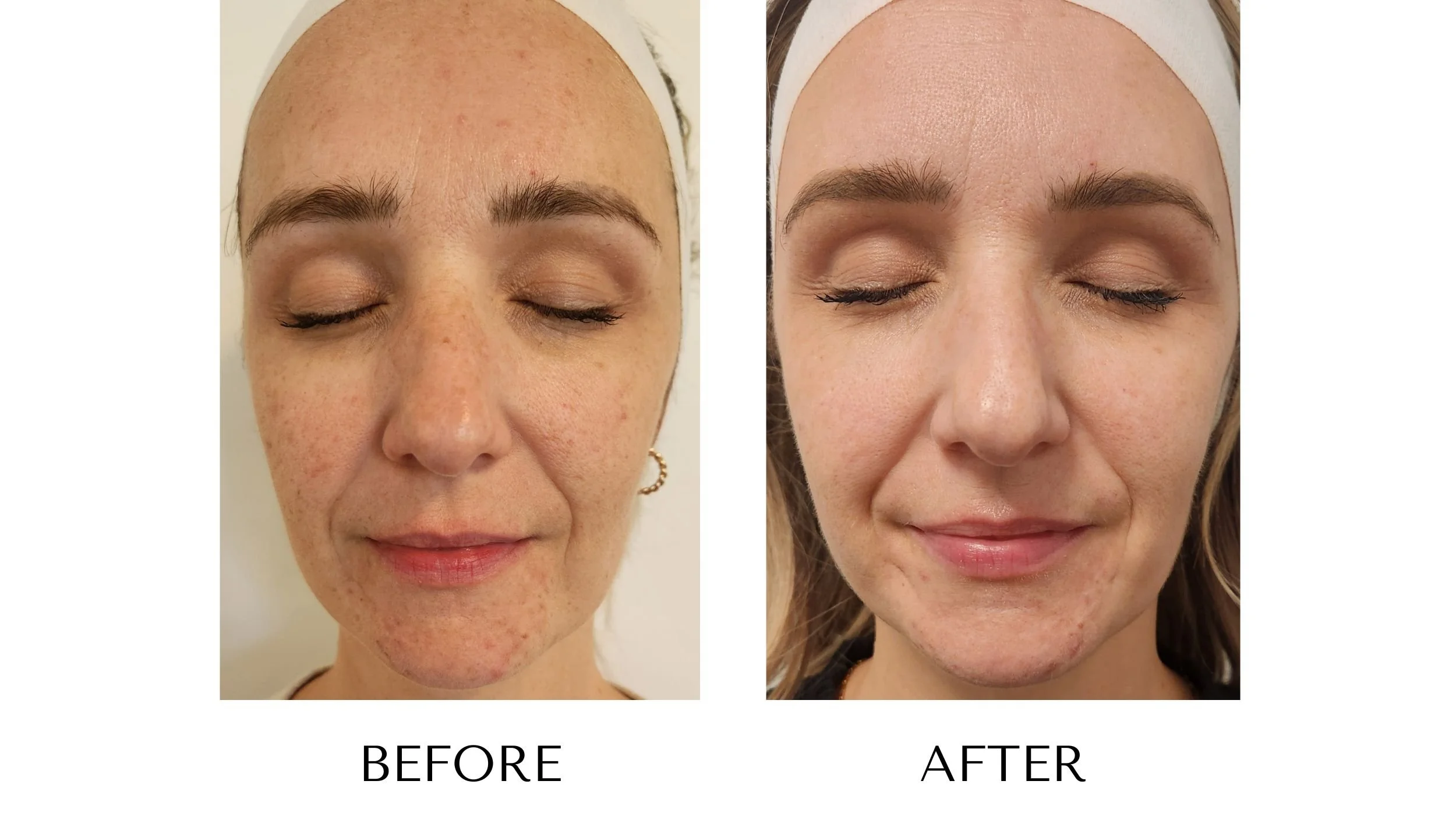 NUYU-laser-skin-rejuvenation-ipl-photofacial-results-6.jpg