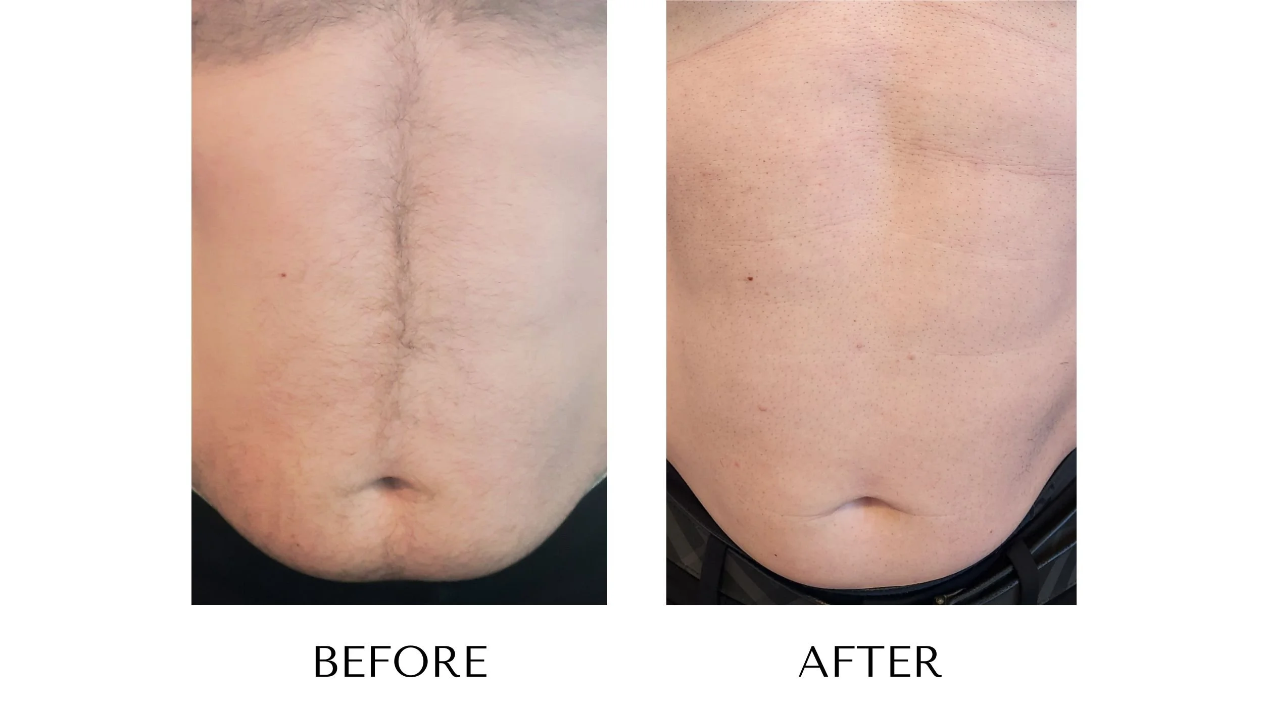 Before and after photos of a man’s smooth, hair-free abdomen after laser hair removal at NUYU Laser & Skin Rejuvenation in Belleville, Ontario.