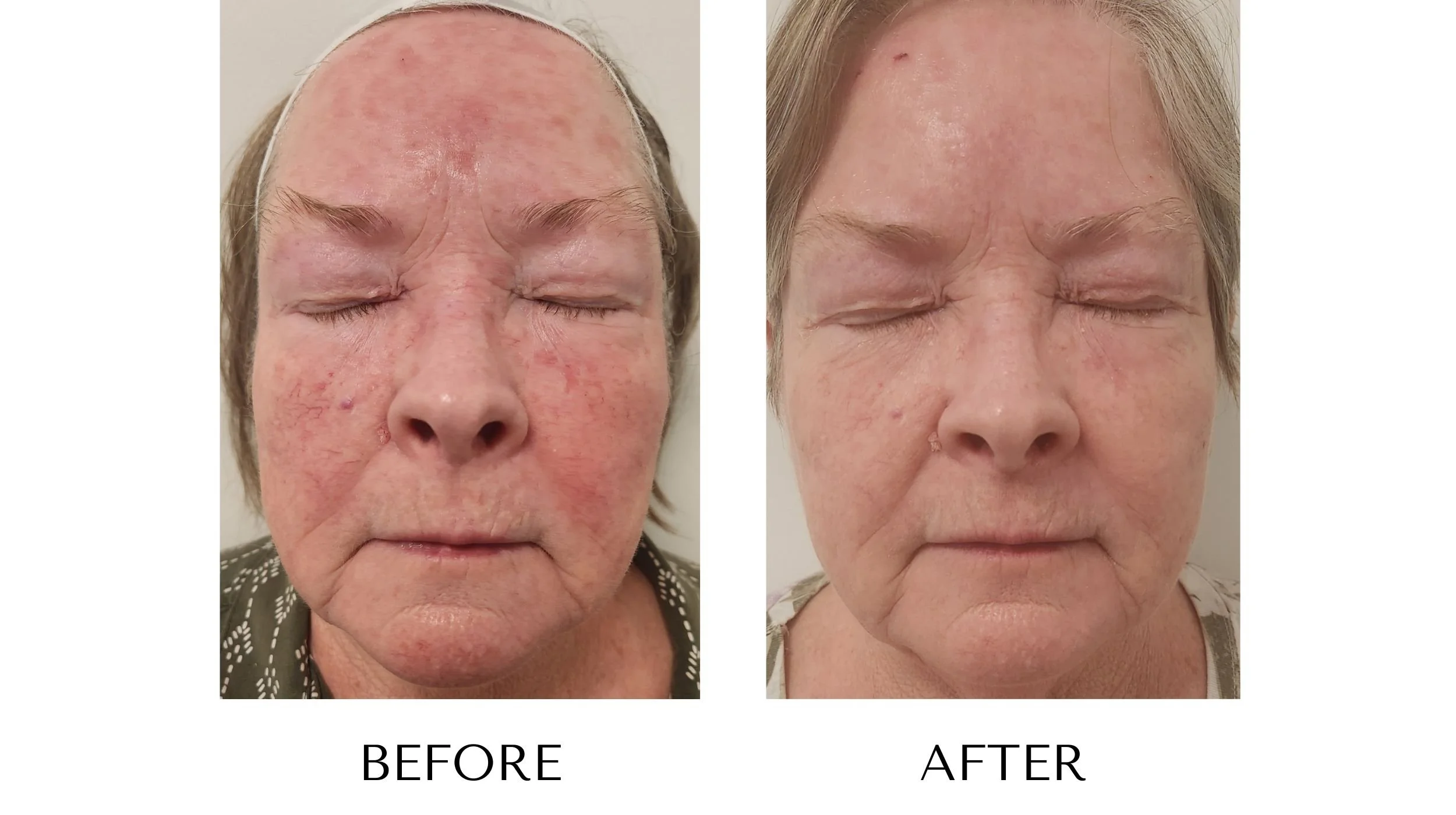 NUYU-laser-skin-rejuvenation-ipl-photofacial-results-8.jpg