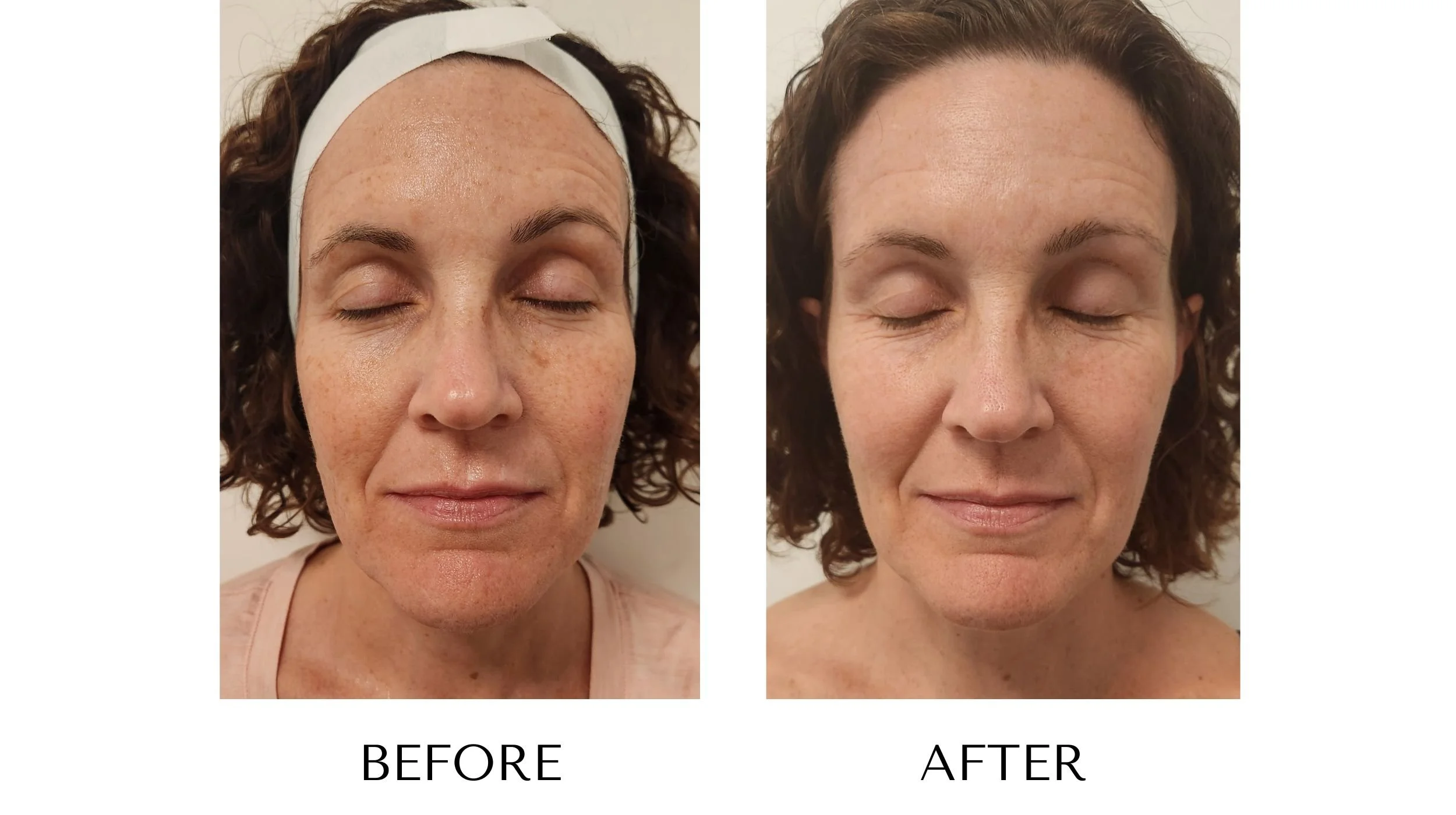 Before and after photos of an IPL photofacial treatment at NUYU Laser & Skin Rejuvenation in Belleville, Ontario, showing improved sun damage, dull skin, fine lines, and wrinkles.